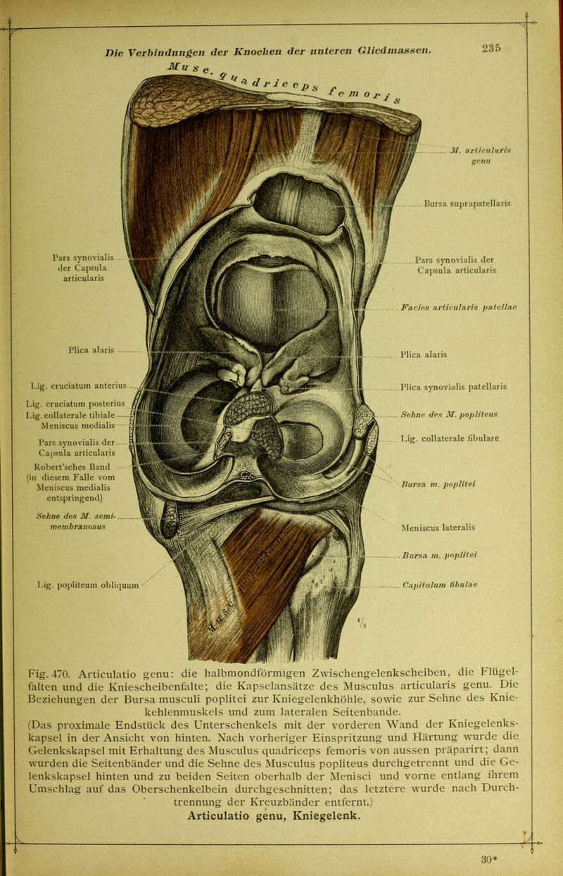 genu Bursa suprapatellaris Die Verbindungen der Knochen der unteren Gliedmassen. JlTyy ~ * * d r i c c p 235 Facies ai'ticularis patellae Plica alaris Plica alaris Bursa in. poplitei Pars synovialis der Capsula articularis „ Pars synovialis der Capsula articularis Ag. popliteum obliquum ' Capitulum fibulae Lig. cruciatum anterius Lig. cruciatum posterius Lig. collaterale tibiale Meniscus medialis Pars synovialis der Capsula articularis Robert’sches Band (in diesem Falle vom Meniscus medialis entspringend) Sehne des M. semi- membranosus Plica synovialis patellaris Sehne des M. popliteus Lig. collaterale fibulare Bursa m. poplitei Meniscus lateralis Fig. 470. Articulatio genu: die halbmondförmigen Zwischengelenkscheiben, die Flügel- falten und die Kniescheibenfalte; die Kapselansätze des Musculus articularis genu. Die Beziehungen der Bursa musculi poplitei zur Kniegelenkhöhle, sowie zur Sehne des Knie- kehlenmuskels und zum lateralen Seitenbande. (Das proximale Endstück des Unterschenkels mit der vorderen Wand der Kniegelenks- kapsel in der Ansicht von hinten. Nach vorheriger Einspritzung und Härtung wurde die Gelenkskapsel mit Erhaltung des Musculus quadriceps femoris von aussen präparirt; dann wurden die Seitenbänder und die Sehne des Musculus popliteus durchgetrennt und die Ge- lenkskapsel hinten und zu beiden Seiten oberhalb der Menisci und vorne entlang ihrem Umschlag auf das Oberschenkelbein durchgeschnitten; das letztere wurde nach Durch- trennung der Kreuzbänder entfernt.) Articulatio genu, Kniegelenk. .k.  30*