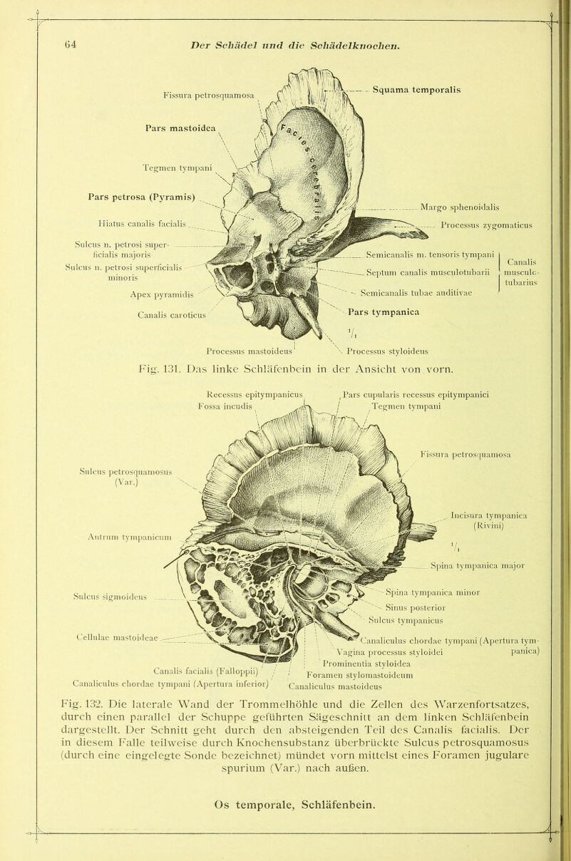 Tegmen tympani Fissura petrosquamosa Squama temporalis Pars mastoidea Pars petrosa (Pyramis) Processus mastoideus Margo sphenoidalis Processus zygomaticus Semicanalis m. tensoris tympani | Canalis Septum canalis musculotubarii musculc- tubarius Semicanalis tubae auditivae Pars tympanica i Processus styloideus Pliatus canalis facialis Apex pyramidis Canalis caroticus Sulcus n. petrosi super- ficialis majoris Sulcus n. petrosi superficialis minoris Fig. 131. Das linke Schläfenbein in der Ansicht von vorn. Recessus epitympanicus Fossa incudis Pars cupularis recessus epitympanici Tegmen tympani Sulcus petrosquamosus (Var.) Antrum tympanicum Sulcus sigmoideus Cellulae mastoideae Incisura tympanica (Rivini) . 1 Spina tympanica major Canalis facialis (Falloppii Canaliculus cbordae tympani (Apertura inferior) ''Spina tympanica minor ''' Sinus posterior Sulcus tympanicus Canaliculus cliordae tympani (Apertura tym- Vagina processus styloidei panica) Prominentia styloidea Foramen stylomastoideum Canaliculus mastoideus Fissura petrosquamosa Fig. 132. Die laterale Wand der Trommelhöhle und die Zellen des Warzenfortsatzes, durch einen parallel der Schuppe geführten Sägeschnitt an dem linken Schläfenbein dargestellt. Der Schnitt geht durch den absteigenden Teil des Canalis facialis. Der in diesem Falle teilweise durch Knochensubstanz überbrückte Sulcus petrosquamosus (durch eine eingelegte Sonde bezeichnet) mündet vorn mittelst eines Foramen jugulare spurium (Var.) nach außen. Ä