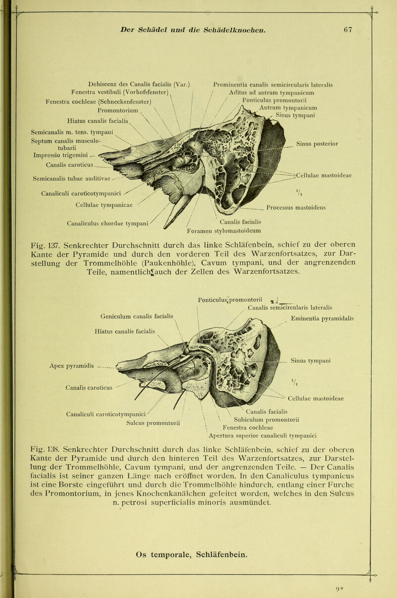 Prominentia canalis semicircularis lateralis / Aditus ad antrum tympanicum Ponticulus promontorii Antrum tympanicum Sinus tympani Semicanalis m. tens. tympani Septum canalis musculo- tubarii Impressio trigemini — Canalis caroticus Semicanalis tubae auditivae -- Sinus posterior mastoideae Canaliculi caroticotympanici Cellulae tympanicae Processus mastoideus Canaliculus chordae tympani Canalis facialis Foramen stylomastoideum Hiatus canalis facialis Dehiscenz des Canalis facialis (Var. Fenestra vestibuli (Vorhofsfenster) t Fenestra cochleae (Schneckenfenster) Promontorium ) Fig. 137. Senkrechter Durchschnitt durch das linke Schläfenbein, schief zu der oberen Kante der Pyramide und durch den vorderen Teil des Warzenfortsatzes, zur Dar- stellung der Trommelhöhle (Paukenhöhle), Cavum tympani, und der angrenzenden Teile, namentlich^auch der Zellen des Warzenfortsatzes. Geniculum canalis facialis Hiatus canalis facialis Ponticulus' promontorii » j Canalis semicircularis lateralis Eminentia pyramidalis Apex pyramidis Canalis caroticus Canaliculi caroticotympanici Sulcus promontorii Sinus tympani Cellulae mastoideae Canalis facialis Subiculum promontorii Fenestra cochleae Apertura superior canaliculi tympanici Fig. 138. Senkrechter Durchschnitt durch das linke Schläfenbein, schief zu der oberen Kante der Pyramide und durch den hinteren Teil des Warzenfortsatzes, zur Darstel- lung der Trommelhöhle, Cavum tympani, und der angrenzenden Teile. — Der Canalis facialis ist seiner ganzen Länge nach eröffnet worden. In den Canaliculus tympanicus ist eine Borste eingeführt und durch die Trommelhöhle hindurch, entlang einer Furche des Promontorium, in jenes Knochenkanälchen geleitet worden, welches in den Sulcus n. petrosi superficialis minoris ausmündet.