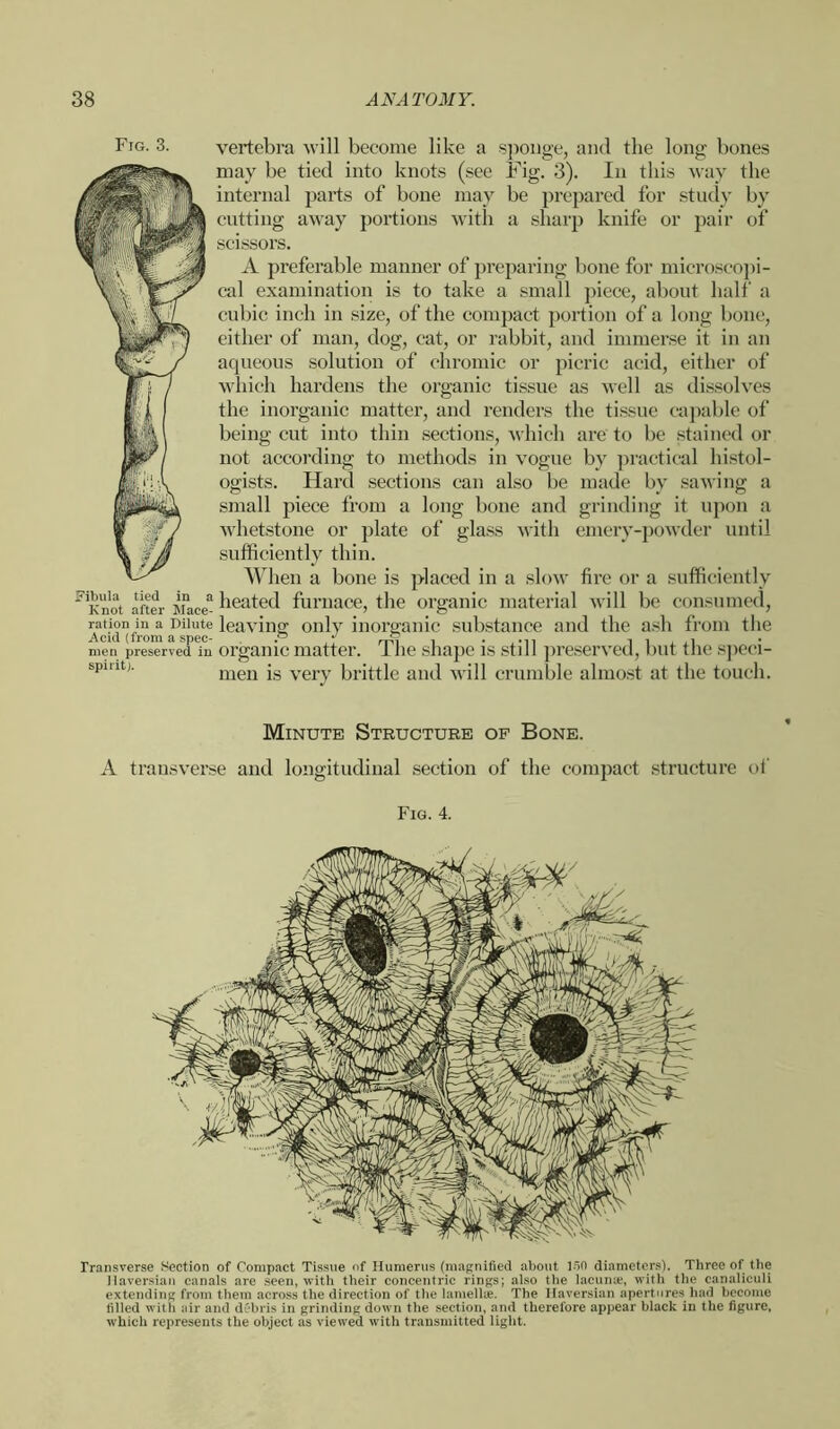 Fig. 3. vertebra will become like a sponge, and the long bones may be tied into knots (see Fig. 3). In this way the internal parts of bone may be prepared for study by cutting away portions with a sharp knife or pair of scissors. A preferable manner of preparing bone for microscopi- cal examination is to take a small piece, about half a cubic inch in size, of the compact portion of a long bone, either of man, dog, cat, or rabbit, and immerse it in an aqueous solution of chromic or picric acid, either of which hardens the organic tissue as well as dissolves the inorganic matter, and renders the tissue capable of being cut into thin sections, which are to be stained or not according to methods in vogue by practical histol- ogists. Hard sections can also be made by sawing a small piece from a long bone and grinding it upon a whetstone or plate of glass with emery-powder until sufficiently thin. When a bone is placed in a slow fire or a sufficiently FKn'ot after mW- ^iea*:(‘<^ furnace, the organic material will be consumed, ration in a Dilute leaving only inorganic substance and the ash from the men preserved in organic matter. Ihe shape is still preserved, but the speci- spmt;' men is very brittle and will crumble almost at the touch. Minute Structure of Bone. A transverse and longitudinal section of the compact structure of Fig. 4. Transverse Section of Compact Tissue of Humerus (magnified about loO diameters). Three of the Haversian canals are seen, with their concentric rings; also the lacunae, with the canaliculi extending from them across the direction of the lamellie. The Haversian apertures had become filled with air and debris in grinding down the section, and therefore appear black in the figure, which represents the object as viewed with transmitted light.