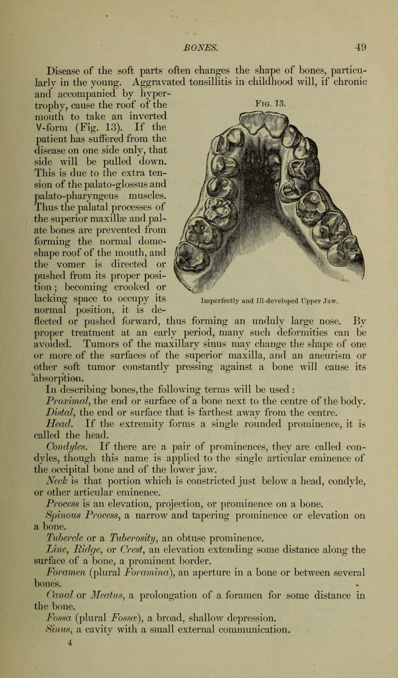 Disease of the soft parts often changes the shape of bones, particu- larly in the young. Aggravated tonsillitis in childhood will, if chronic and accompanied by hyper- trophy, cause the roof of the Fig. 13. mouth to take an inverted V-form (Fig. 13). If the patient has suffered from the disease on one side only, that side will be pulled down. This is due to the extra ten- sion of the palato-glossus and palato-pharyngeus muscles. Thus the palatal processes of the superior maxilla? and pal- ate bones are prevented from forming the normal dome- shape roof of the mouth, and the vomer is directed or pushed from its proper posi- tion ; becoming crooked or lacking space to occupy its Imperfectly and Ill-developed Upper Jaw. normal position, it is de- flected or pushed forward, thus forming an unduly large nose. By proper treatment at an early period, many such deformities can be avoided. Tumors of the maxillary sinus may change the shape of one or more of the surfaces of the superior maxilla, and an aneurism or other soft tumor constantly pressing against a bone will cause its absorption. In describing bones,the following terms will be used : Proximal, the end or surface of a bone next to the centre of the bodv. Distal, the end or surface that is farthest away from the centre. Head. If the extremity forms a single rounded prominence, it is called the head. Condyles. If there are a pair of prominences, they are called con- dyles, though this name is applied to the single articular eminence of the occipital bone and of the lower jaw. Neck is that portion which is constricted just below a head, condyle, or other articular eminence. Process is an elevation, projection, or prominence on a bone. Spinous Process, a narrow and tapering prominence or elevation on a bone. Tubercle or a Tuberosity, an obtuse prominence. Tine, Ridge, or Crest, an elevation extending some distance along the surface of a bone, a prominent border. Foramen (plural Foramina), an aperture in a bone or between several bones. Canal or Meatus, a prolongation of a foramen for some distance in the bone. Fossa (plural Fossce), a broad, shallow depression. Sinus, a cavity with a small external communication.