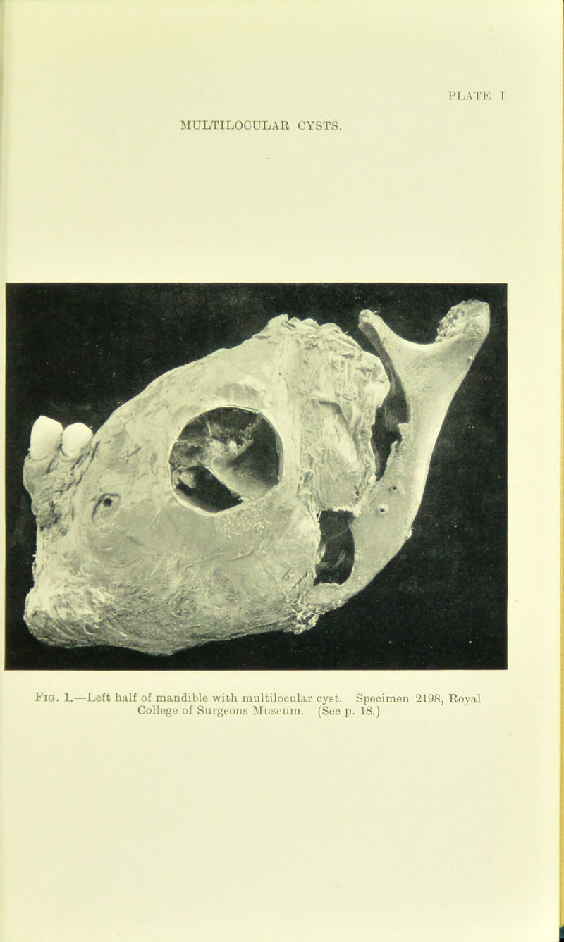 MULTILOGULAR CYSTS. Fig. 1.—Left half of mandible with multilocular cyst. Specimen 2198, Royal College of Surgeons Museum. (See p. 18.)