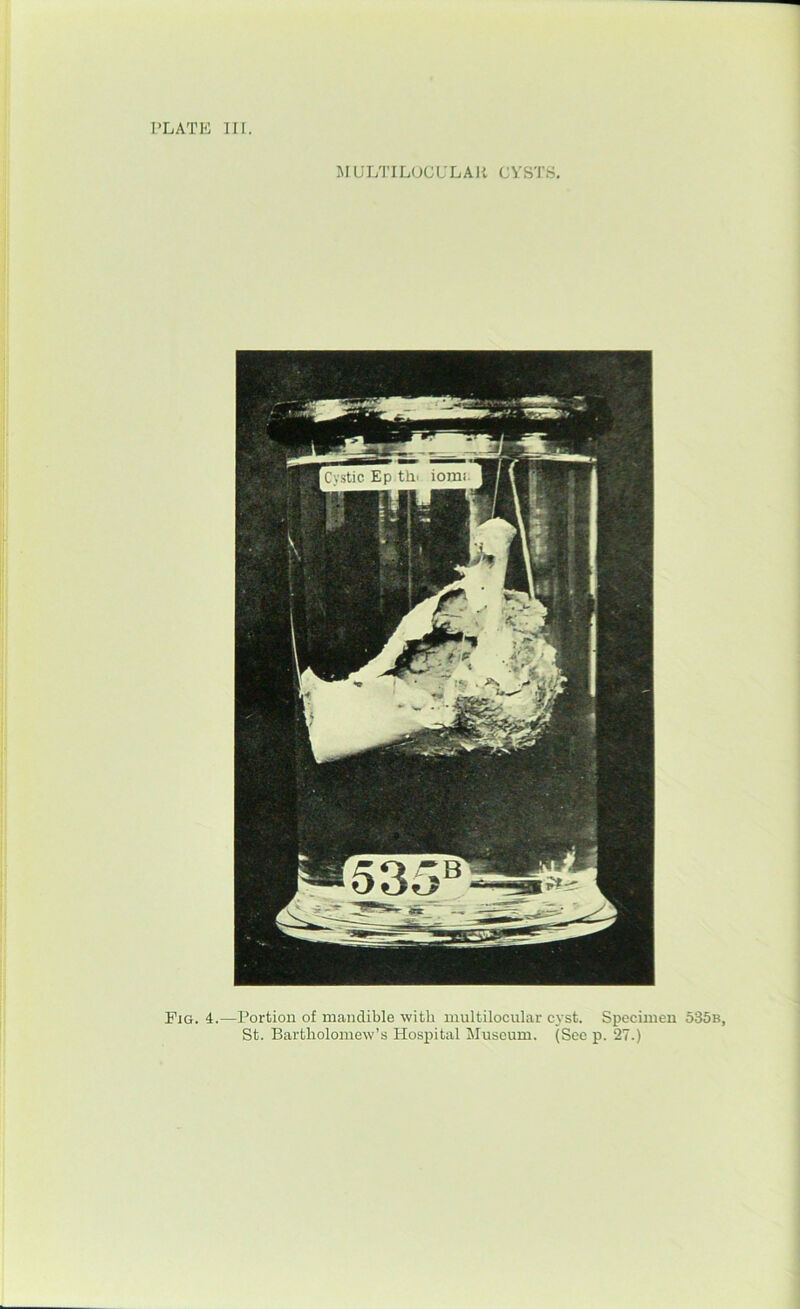 MULTILOCULAK CYSTS. Fig. 4.—Portion of mandible with multilocular cyst. Specimen 535b,