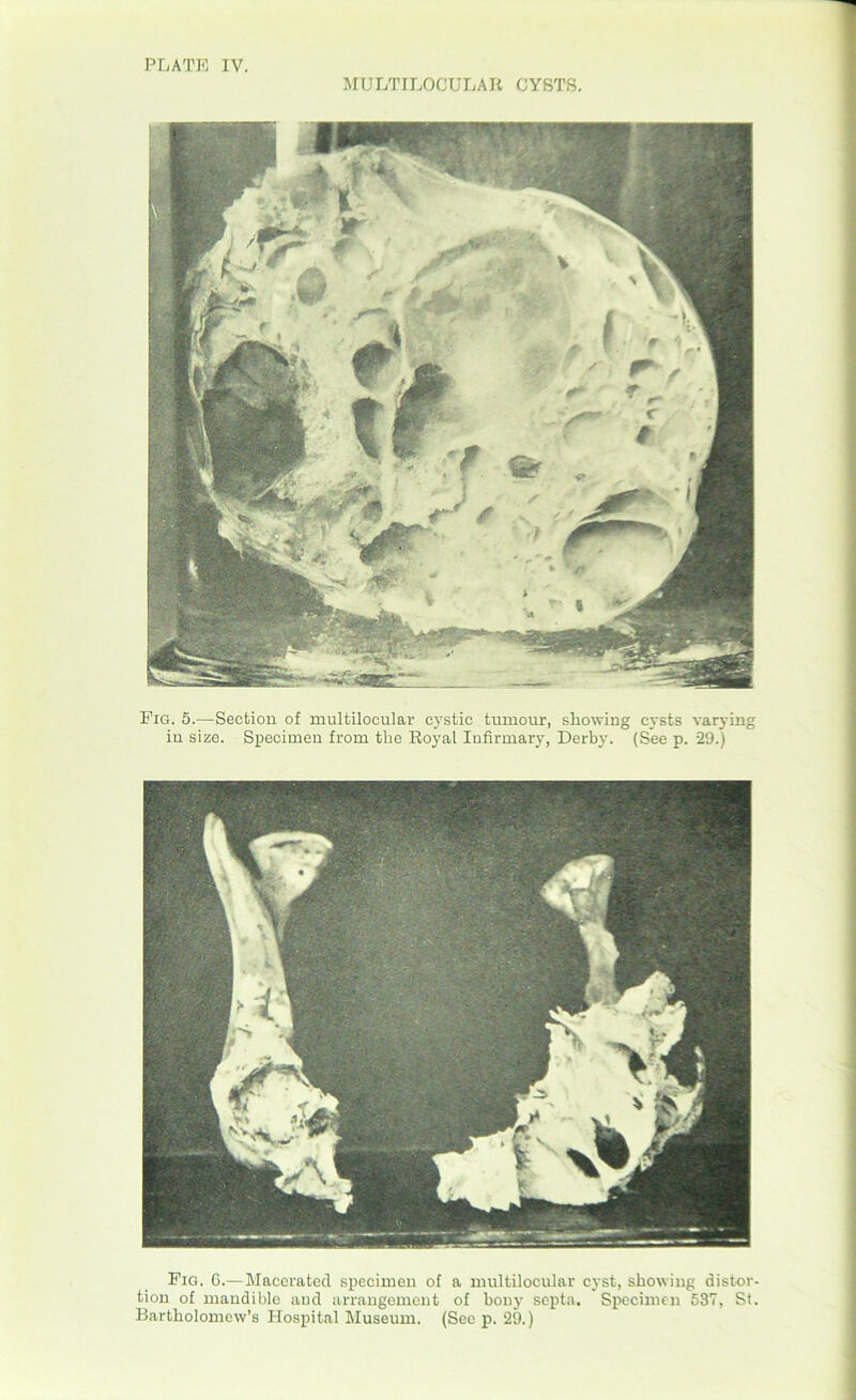 MULTILOCULAR CYSTS. Pig. 5.—Section of multilocular cystic tumour, showing cysts varying in size. Specimen from the Royal Infirmary, Derby. (See p. 29.) Fig. 6.—Macerated specimen of a multilocular cyst, showing distor- tion of mandible and arrangement of bony septa. Specimen 537, St. Bartholomew’s Hospital Museum. (Sec p. 29.)