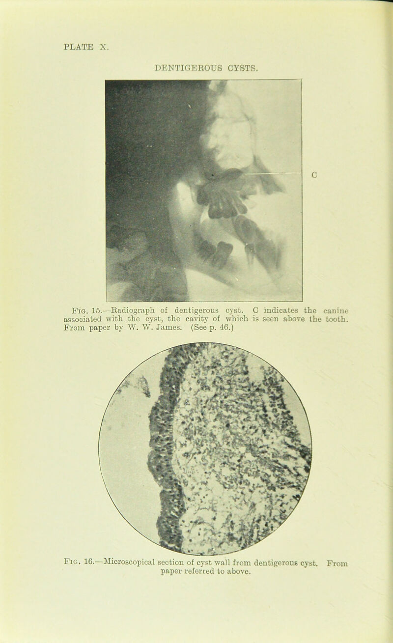 DENTIGEROUS CYSTS. Pig. 15.—Radiograph of dentigerous cyst. C indicates the associated with the cyst, the cavity of which is seen above the Prom paper by W. W. James. (See p. 46.) Fig. 16.—Microscopical section of cyst wall from dentigerous cyst. paper referred to above. canine tooth. From