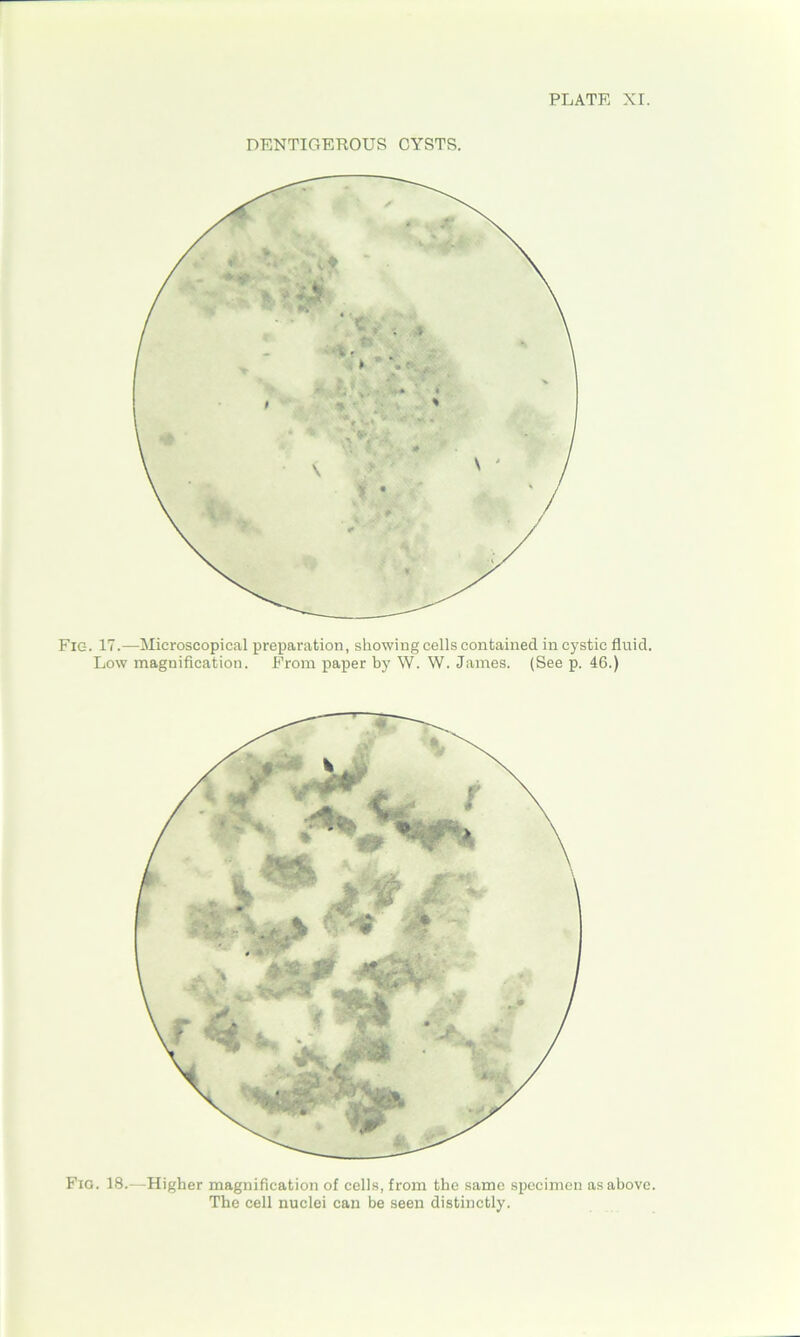 DENTIGEROUS CYSTS. Fig. 17.—Microscopical preparation, showing cells contained in cystic fluid. Low magnification. From paper by W. W. James. (See p. 46.) Fio. 18.—Higher magnification of cells, from the same specimen as above. The cell nuclei can be seen distinctly.