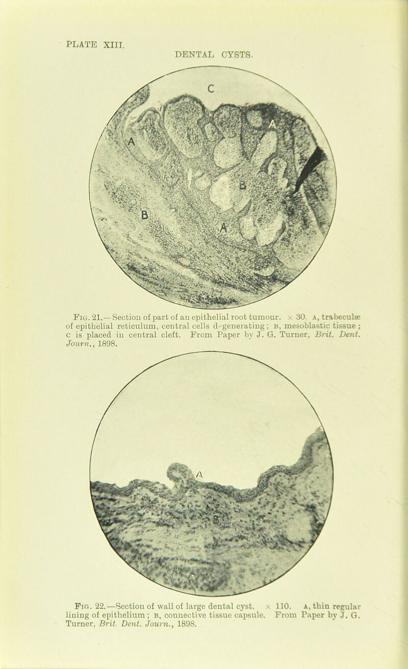 DENTAL CYSTS. Pm. 21.— Section of part of au epithelial root tumour, x 30. a, trabeculae of epithelial reticulum, central cells degenerating ; b, mesoblastic tissue ; c is placed in central cleft. Prom Paper by J. G. Turner, Brit. Dent. Journ., 1898. Pig. 22.—Section of wall of large dental cyst, x 110. a, thin regular lining of epithelium ; b, connective tissue capsule. From Paper by J. G. Turner, Brit. Dent. Journ., 1898.