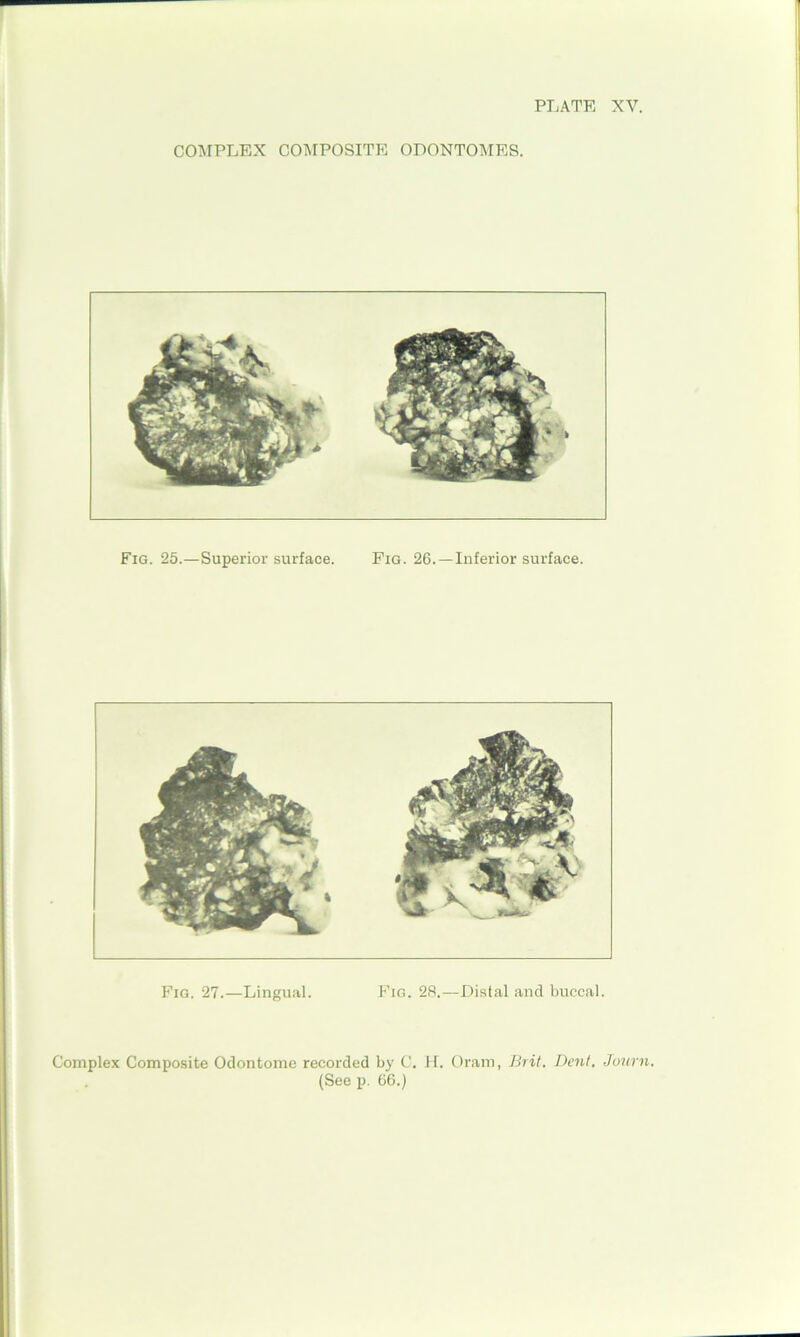 COMPLEX COMPOSITE ODONTOMES. Fig. 25.—Superior surface. Fig. 26. —Inferior surface. Fig. 27.—Lingual. Fig. 28.—Distal and buccal. Complex Composite Odontome recorded by C. H. Oram, Brit. Dent. Journ. (See p. 66.)