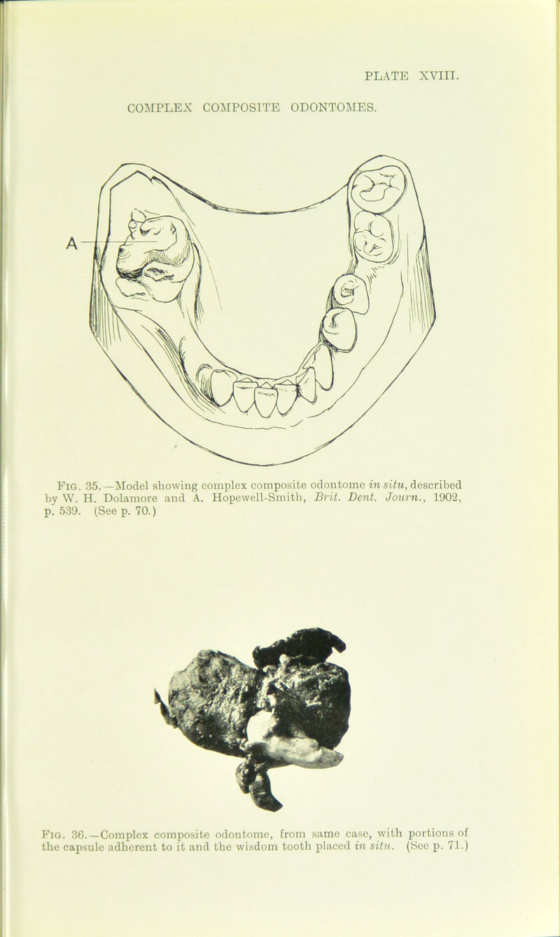 COMPLEX COMPOSITE ODONTOMES. Fig. 35.— Model showing complex composite odontome in situ, described by W. H. Dolamore and A. Hopewell-Smitb, Brit. Dent. Journ., 1902, p.539. (Seep. 70.) Fig. 36.—Complex composite odontome, from same case, with portions of