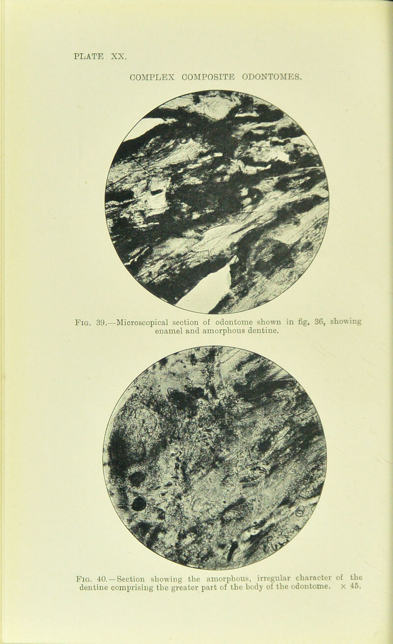 COMPLEX COMPOSITE ODONTOMES. Pig. 39.—Microscopical section of odontome shown in fig, 36, showing enamel and amorphous dentine. Pig. 40.—Section showing the amorphous, irregular character of the dentine comprising the greater part of the body of the odontome. x 45.