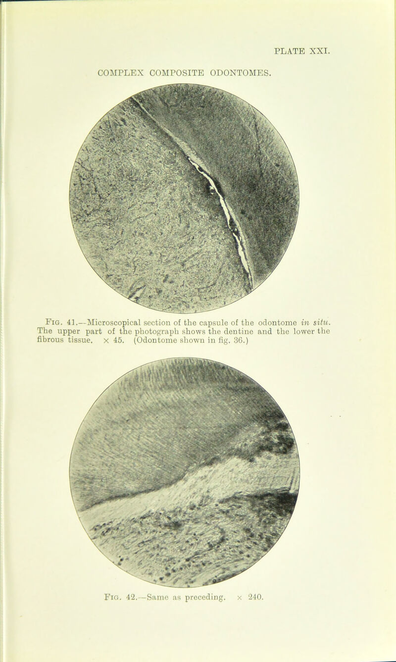 COMPLEX COMPOSITE ODONTOMES. Fig. 41.—Microscopical section of the capsule of the odontome in situ. The upper part of the photograph shows the dentine and the lower the fibrous tissue, x 45. (Odontome shown in fig. 36.) Fig. 42.—Same as preceding, x 240.