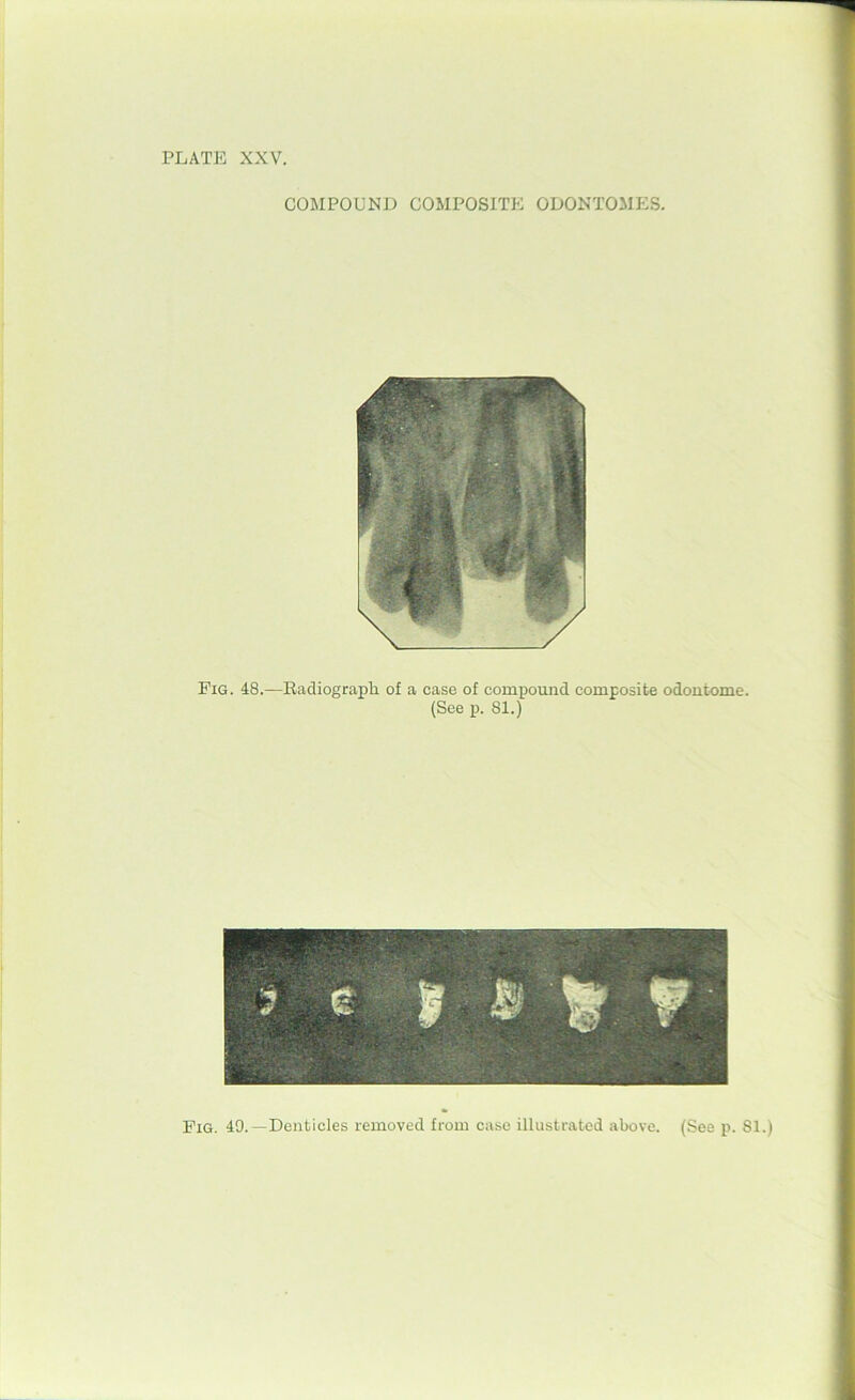 COMPOUND COMPOSITE ODONTOMES. Fig. 48.—Radiograph of a case of compound composite odontome. (See p. 81.) Fig. 49.—Denticles removed from case illustrated above. (See p. 81.)