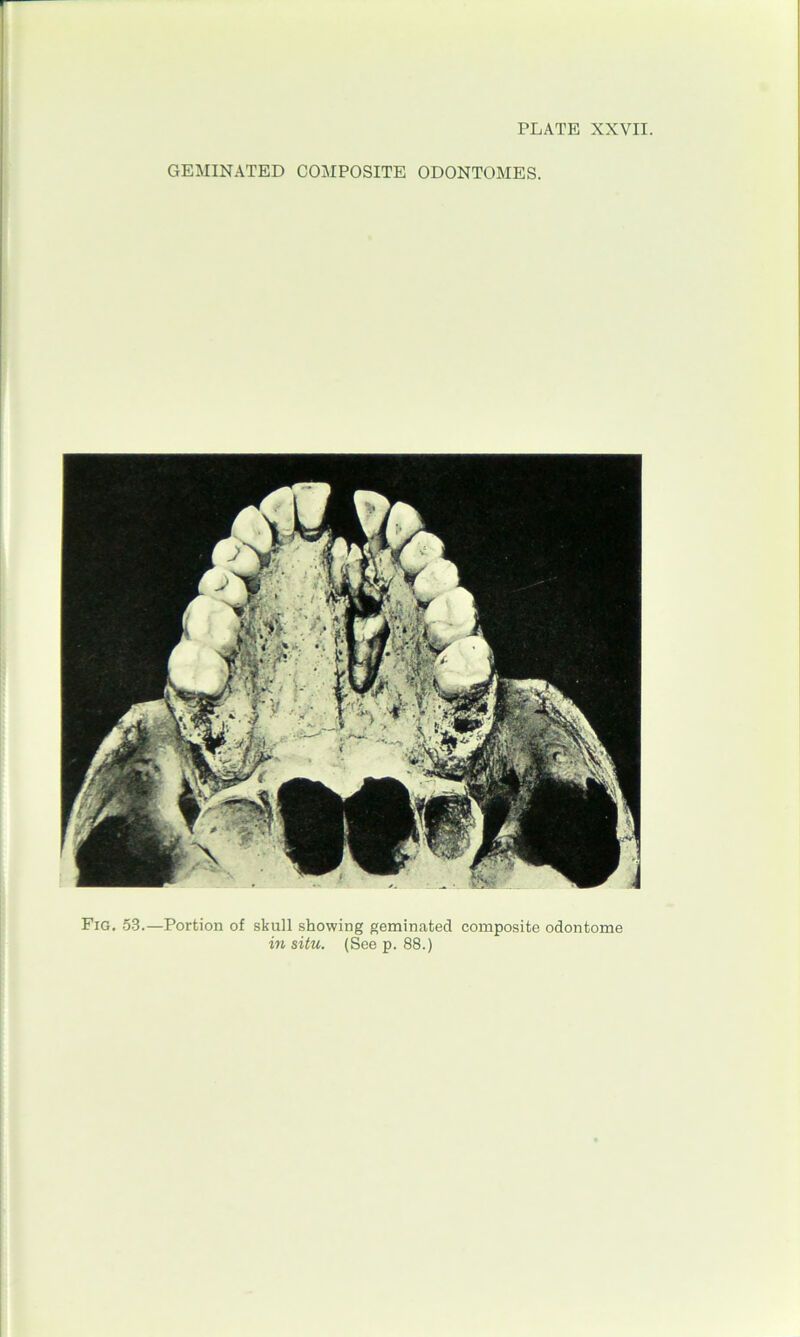 GEMINATED COMPOSITE ODONTOMES. Fig. 53.—Portion of skull showing geminated composite odontome