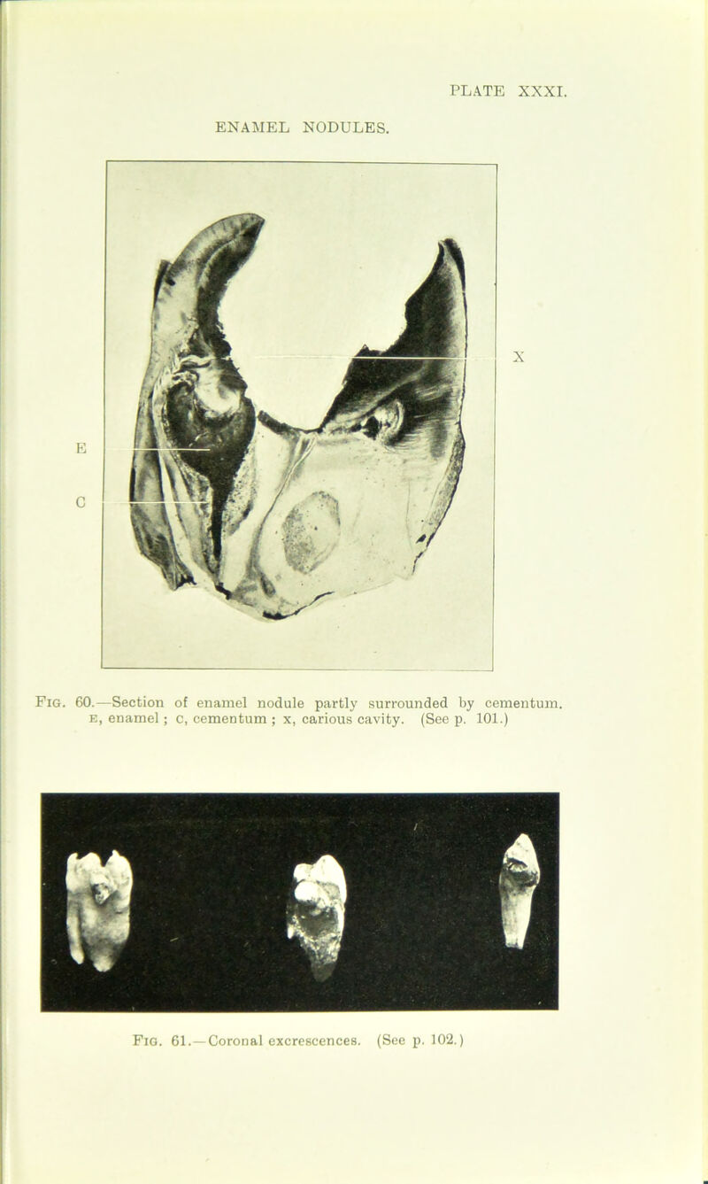 ENAMEL NODULES. Fig. 60.—Section of enamel nodule partly surrounded by cementum. E, enamel; c, cementum ; x, carious cavity. (See p. 101.) Fig. 61.—Coronal excrescences. (See p. 102.)