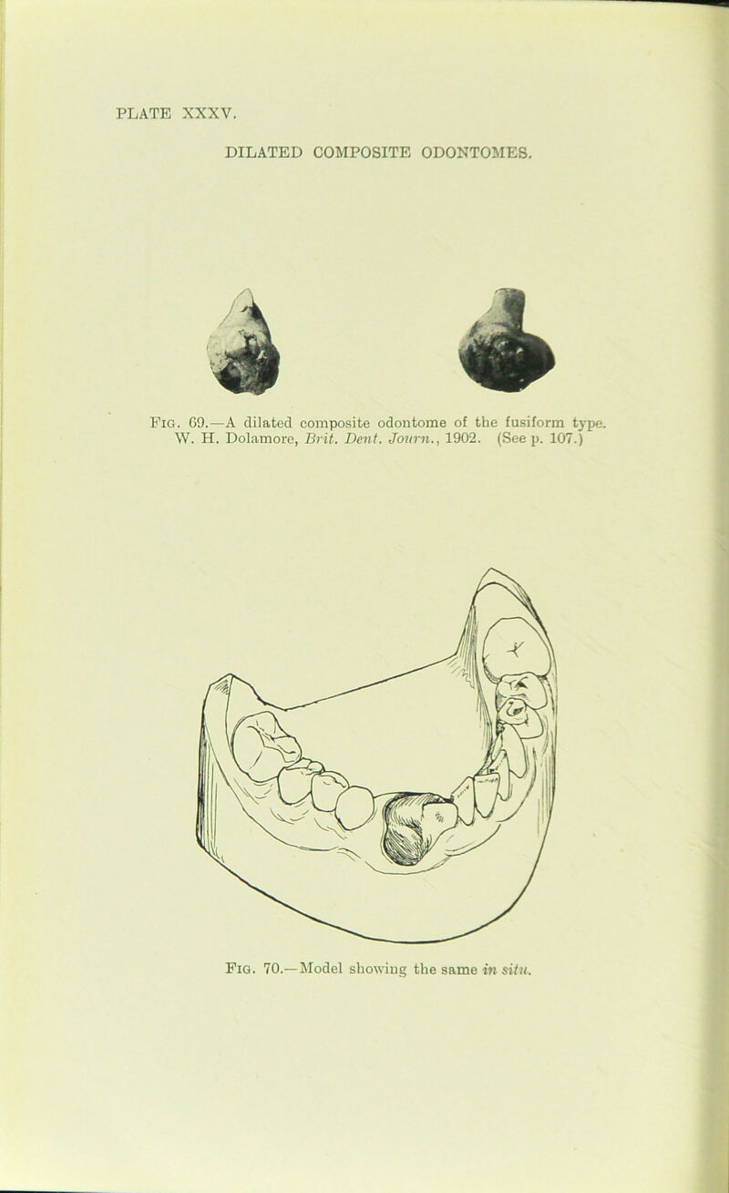 DILATED COMPOSITE ODONTOMES. Pig. 69.—A dilated composite odontome of the fusiform type. W. H. Dolamore, Brit. Dent. Journ., 1902. (See p. 107.) Pig. 70.—Model showing the same in situ.