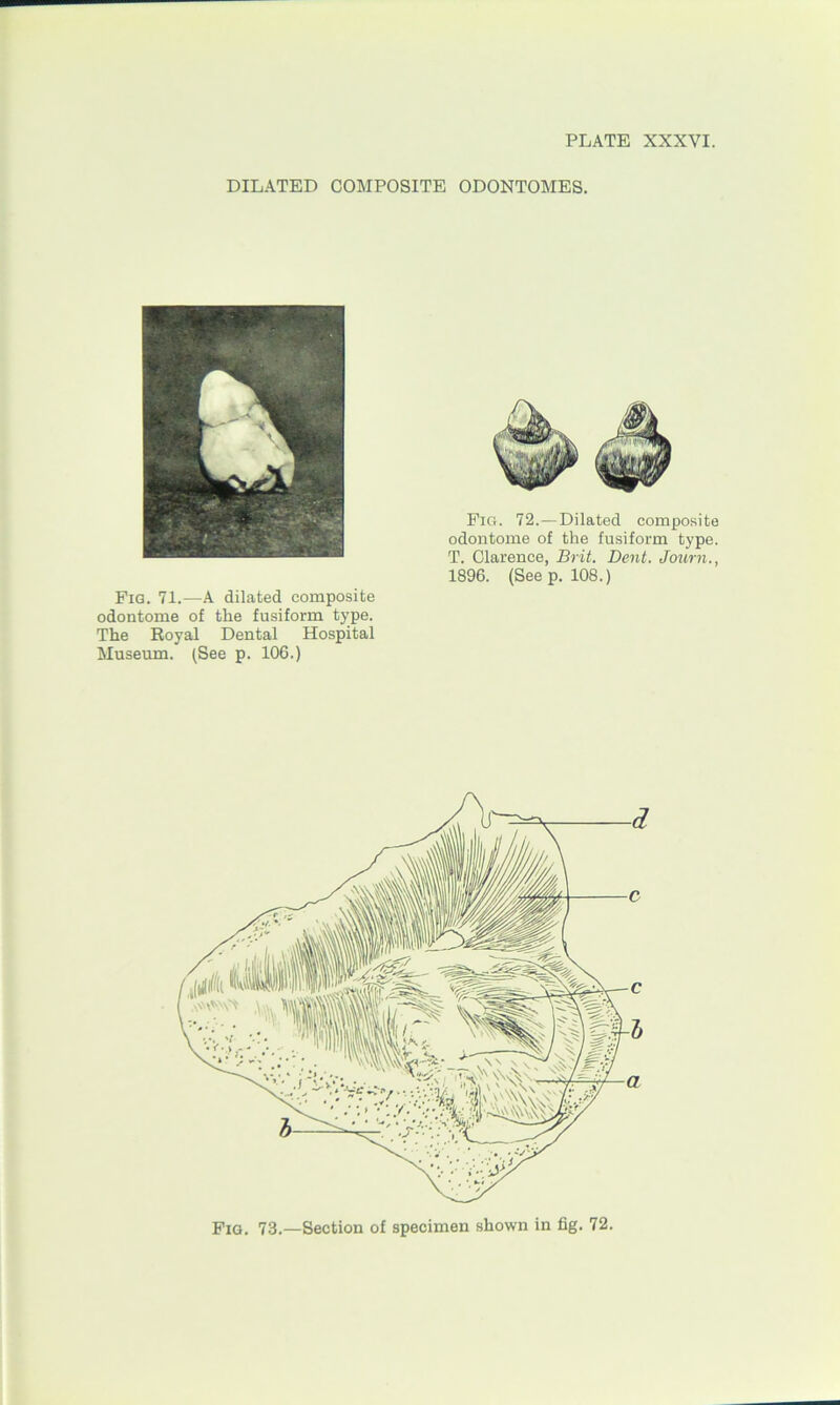 DILATED COMPOSITE ODONTOMES. Pig. 72.—Dilated composite odontome of the fusiform type. T. Clarence, Brit. Dent. Journ., 1896. (Seep. 108.) Pig. 71.—A dilated composite odontome of the fusiform type. The Royal Dental Hospital Museum. (See p. 106.)