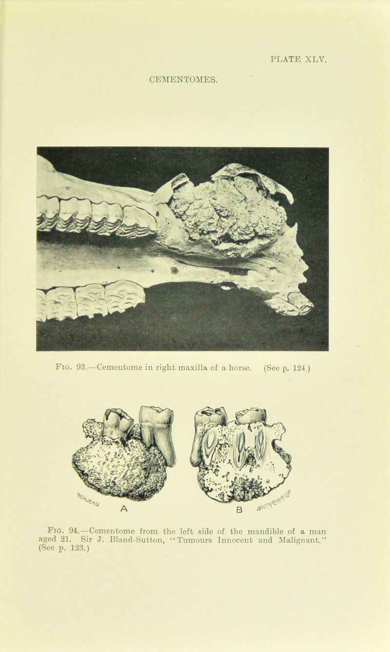 PLATE XLV. CEMENTOMES. Fig. 94.—Cementome from the left side of the mandible of a man aged 21. Sir J. Bland-Sutton, “Tumours Innocent and Malignant.”