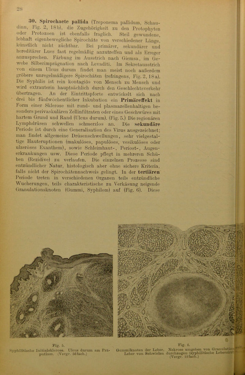 >>0. Spirochaete pallida (Treponema pallidum, Scliau- dinn, Fig. 2, 18b), die Zugehörigkeit zu den Protophyten odei 1 rotozoen ist ebenlalls fraglich. Steil gewundene, lebhaft eigenbewegliche Spirochäte von verschiedener Länge, künstlich nicht züchtbar. Bei primärer, sekundärer und hereditärer Lues fast regelmäßig anzutreffen und als Erreger anzusprechen. Färbung im Ausstrich nach Ctiemsa, im Ge- webe Silberimprägnation nach Levaditi. Im Sekretausstrich von einem Ulcus durum findet man meist noch außerdem gröbere unregelmäßigere Spirochäten (refringens, Fig. 2,18a). Die Syphilis ist rein kontagiös von Mensch zu Mensch und wird extrauterin hauptsächlich durch den Geschlechtsverkehr übertragen. An der Eintrittspforte entwickelt sich nach drei bis fünf wöchentlicher Inkubation ein Primäreffekt in Form einer Sklerose mit rund- und plasmazellenhaltigen be- sonders perivaskulären Zellinfiltraten oder eines Geschwüres mit hartem Grund und Rand (Ulcus durum). (Fig. 5.) Die regionären Lymphdrüsen schwellen schmerzlos an. Die sekundäre Periode ist durch eine Generalisation des Virus ausgezeichnet; man findet allgemeine Drüsenschwellungen, sehr vielgestal- tige Hauteruptionen (makulöses, papulöses, vesikulöses oder ulzeröses Exanthem), sowie Schleimhaut-, Periost-, Augen- erkrankungen usw. Diese Periode pflegt in mehreren Schü- ben (Rezidive) zu verlaufen. Die einzelnen Prozesse sind entzündlicher Natur, histologisch aber ohne sichere Kriteria, falls nicht der Spirochätennachweis gelingt. In der tertiären Periode treten in verschiedenen Organen teils entzündliche Wucherungen, teils charakteristische zu Verkäsung neigende Granulationsknoten (Gummi, Syphilom) auf (Fig. 6). Diese Fig. 5. Fig. G. Syphilitische Initialsklerose. Ulcus durum am Prä- Gummiknoten der Leber. Nekrose umgeben von Granulation^ 1 putium. (Vergr. 56fach.) Leber von Schwielen durchzogen (syphilitische Leberzirrijr (Vergr. 12 fach.)