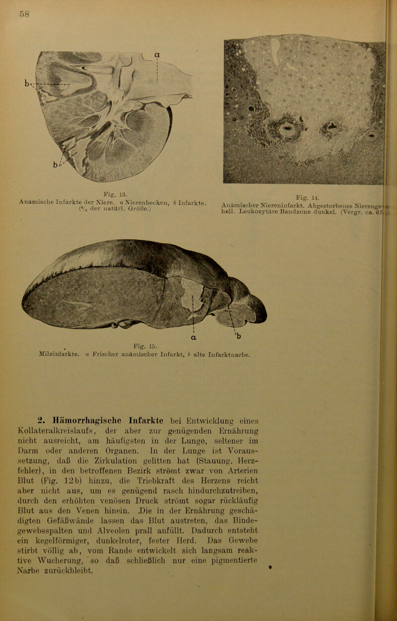 Fig. 13. Anämische Infarkte cler Niere, a Nierenbecken, b Infarkte. (4/5 der natürl. Größe.) Anämischer Niereninfarkt. Abgestorbenes Nierengei hell. Leukozytäre Bandzone dunkel. (Vergr. ca. 6f »e U) . Fig. 15. Milzinfarkte, a Frischer anämischer Infarkt, b alte Infarktnarbe. 2. Hämorrhagische Infarkte bei Entwicklung eines Kollateralkreislaufs, der aber zur genügenden Ernährung nicht ausreicht, am häufigsten in der Lunge, seltener im Darm oder anderen Organen. In der Lunge ist Voraus- setzung, daß die Zirkulation gelitten hat (Stauung. Herz- fehler), in den betroffenen Bezirk strömt zwar von Arterien Blut (Fig. 12b) hinzu, die Triebkraft des Herzens reicht aber nicht aus, um es genügend rasch hindurchzutreiben, durch den erhöhten venösen Druck strömt sogar rückläufig Blut aus den Venen hinein. Die in der Ernährung geschä- digten Gefäßwände lassen das Blut austreten, das Binde- gewebsspalten und Alveolen prall anfüllt. Dadurch entsteht ein kegelförmiger, dunkelroter, fester Herd. Das Gewebe stirbt völlig ab, vom Rande entwickelt sich langsam reak- tive Wucherung, so daß schließlich nur eine pigmentierte Narbe zurückbleibt.