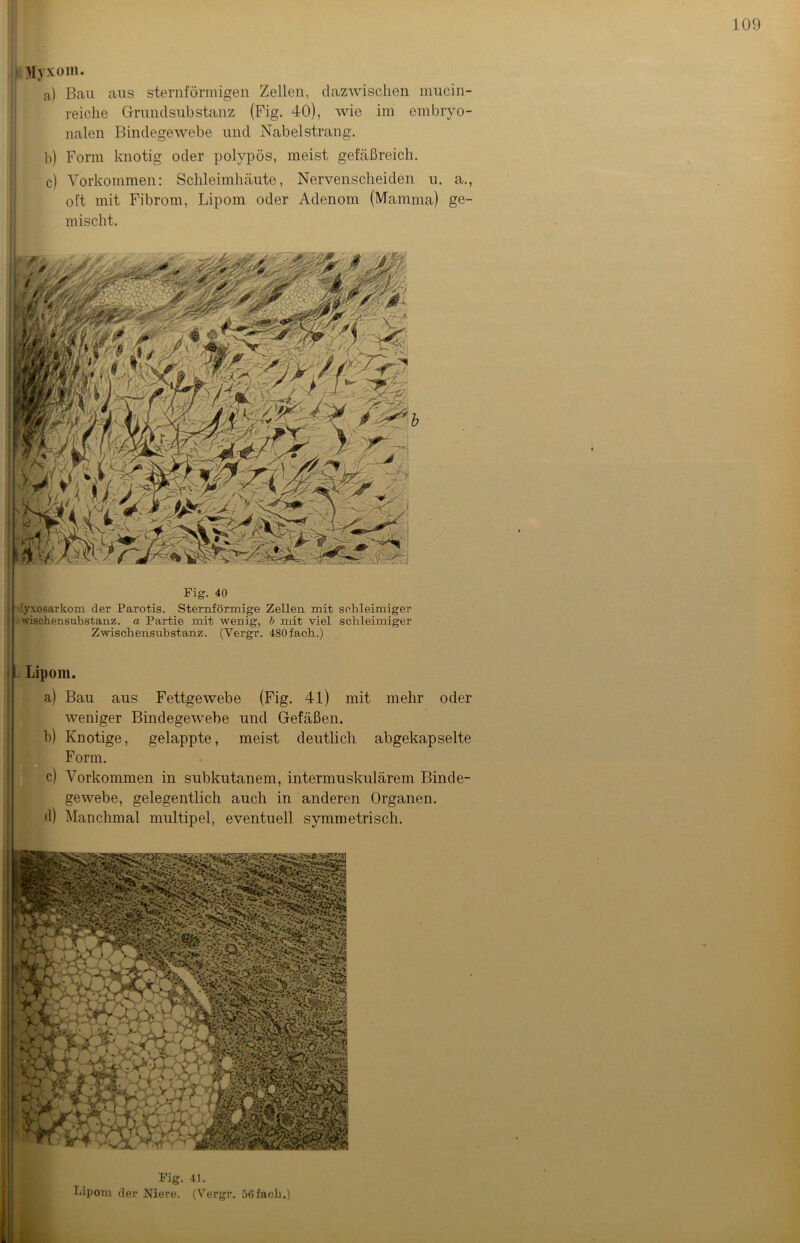 Myxom. a) Bau aus sternförmigen Zellen, dazwischen mucin- reiche Grundsubstanz (Fig. 40), wie im embryo- nalen Bindegewebe und Nabelstrang. b) Form knotig oder polypös, meist gefäßreich. c) Vorkommen: Schleimhäute, Nervenscheiden u. a., oft mit Fibrom, Lipom oder Adenom (Mamma) ge- mischt. Fig. 40 [yxosarkom der Parotis. Sternförmige Zellen mit schleimiger wischensubstanz. a Partie mit wenig, b mit viel schleimiger Zwischensubstanz. (Vergr. 480fach.) Lipom. a) Bau aus Fettgewebe (Fig. 41) mit mehr oder (weniger Bindegewebe und Gefäßen. b) Knotige, gelappte, meist deutlich abgekapselte Form. c) Vorkommen in subkutanem, intermuskulärem Binde- gewebe, gelegentlich auch in anderen Organen, d) Manchmal multipel, eventuell symmetrisch. Fig. 41. bipom der Niere. (Vergr. 56fach.)