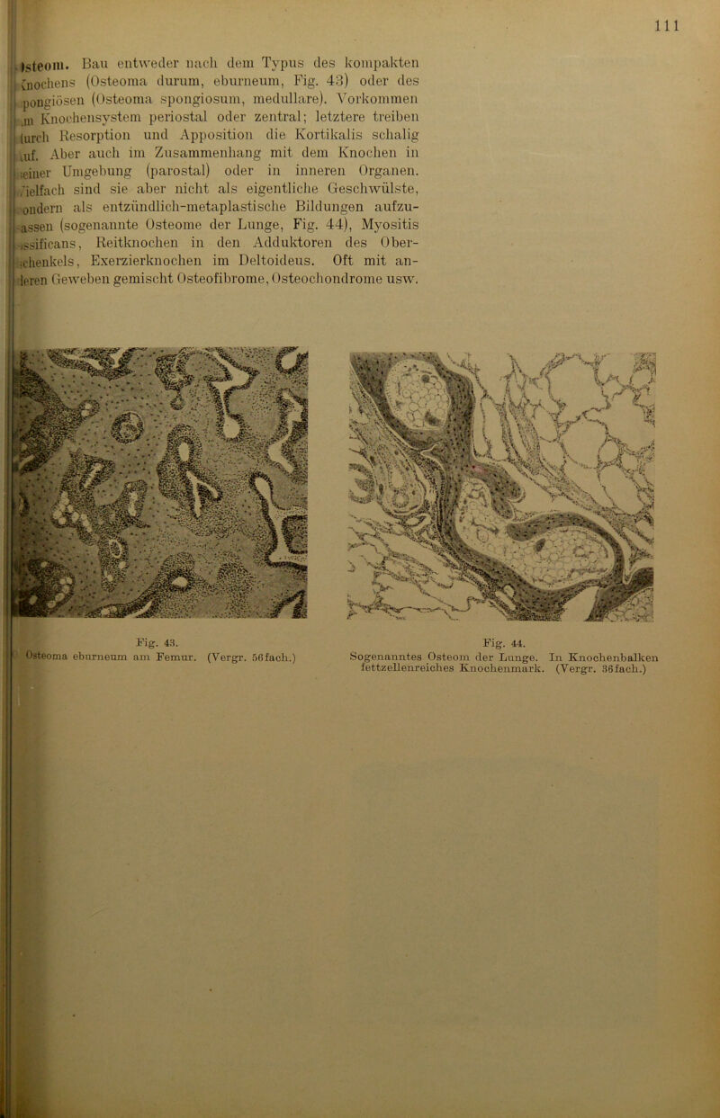 Isteom. Bau entweder nach dem Typus des kompakten I (nochens (Osteoma durum, eburneum, Fig. 43) oder des j ipongiösen (Osteoma spongiosum, medulläre). Vorkommen I m Knochensystem periostal oder zentral; letztere treiben i lurcli Resorption und Apposition die Kortikalis schalig iUf. Aber auch im Zusammenhang mit dem Knochen in j seiner Umgebung (parostal) oder in inneren Organen, j Vielfach sind sie aber nicht als eigentliche Geschwülste, { oudern als entzündlich-metaplastische Bildungen aufzu- assen (sogenannte Osteome der Lunge, Fig. 44), Myositis /ssificans, Reitknochen in den Adduktoren des Ober- schenkels, Exerzierknochen im Deltoideus. Oft mit an- dren Geweben gemischt Osteofibrome, Osteochondrome usw. Fig. 43. Osteoma eburneum am Femur. (Yergr. 56 fach.) Fig. 44. Sogenanntes Osteom der Lunge. In Knochenbalken fettzellenreiches Knochenmark. (Yergr. 36fach.)