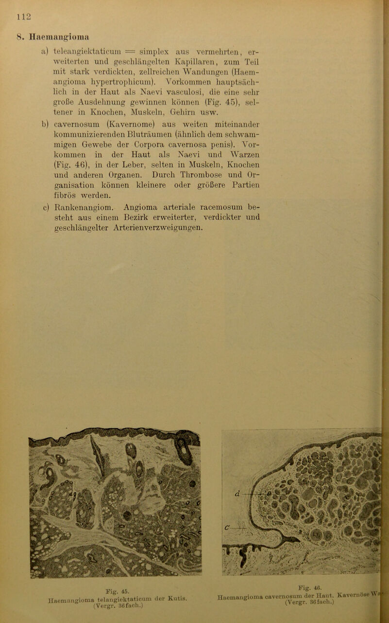 8. Haemangioma a) teleangiektaticum = simplex aus vermehrten, er- weiterten und geschlängelten Kapillaren, zum Teil mit stark verdickten, zellreichen Wandungen (Haem- angioma hypertrophicum). Vorkommen hauptsäch- lich in der Haut als Naevi vasculosi, die eine sehr große Ausdehnung gewinnen können (Fig. 45), sel- tener in Knochen, Muskeln, Gehirn usw. b) cavernosum (Kavernome) aus weiten miteinander kommunizierenden Bluträumen (ähnlich dem schwam- migen Gewebe der Corpora cavernosa penis). Vor- kommen in der Haut als Naevi und Warzen (Fig. 46), in der Leber, selten in Muskeln, Knochen und anderen Organen. Durch Thrombose und Or- ganisation können kleinere oder größere Partien fibrös werden. c) Rankenangiom. Angioma arteriale racemosum be- steht aus einem Bezirk erweiterter, verdickter und geschlängelter Arterienverzweigungen. Fig. 45. Haemangioma telangiektaticum der Kutis. (Vergr. 36 fach.) Fig. 46. Haemangioma cavernosum der Haut. Kavernöse Wo R (Vergr. 36fach.)