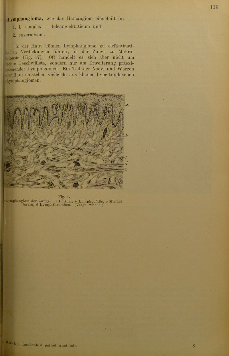Lyrophangioma, wie das Hämangiom eingeteilt in: 1. L. simplex — teleangiektaticum und 2 cavernosum. ln der Haut können Lymphangiome zu elefantiasti- 1 sehen Verdickungen führen, in der Zunge zu Makro- rlossie (Fig. 47). Oft handelt es sich aber nicht um 'eilte Geschwülste, sondern nur um Erweiterung präexi- stierender Lymphbahnen. Ein Teil der Naevi und Warzen ler Haut entstehen vielleicht aus kleinen hypertrophischen j Lvmphangiomen. Fig. 47. Lymphangiom der Zunge, a Epithel, b Lymphgefäße, c Muskel- fasern, cl Lymplitkromben. (Vergr. '20 fach.) R rkt, laschenb. d. pathol. Anatomie. 8