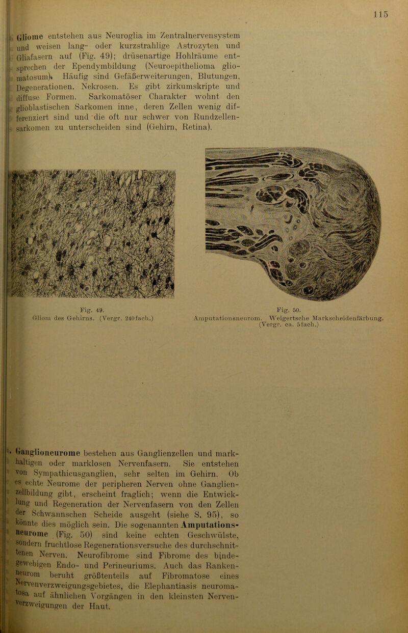 I Gliome entstellen aus Neuroglia im Zentralnervensystem und weisen lang- oder kurzstrahlige Astrozyten und Gliafasern auf (Fig. 49); drüsenartige Hohlräume ent- sprechen der Ependymbildung (Neuroepithelioma glio- i matosum)* Häufig sind Gefäßerweiterungen, Blutungen, Degenerationen. Nekrosen. Es gibt zirkumskripte und diffuse Formen. Sarkomatöser Charakter wohnt den glioblastischen Sarkomen inne, deren Zellen wenig dif- ferenziert sind und die oft nur schwer von Rundzellen- sarkomen zu unterscheiden sind (Gehirn, Retina). Fig. 49. Gliom des Gehirns. (Yergr. 240 fach.) Fig. 50. Amputationsneurom. Weigertsche Markscheidenfärbung. (Yergr. ca. 5fach.) . Uanglioneurome bestehen aus Ganglienzellen und mark- haltigen oder marklosen Nervenfasern. Sie entstehen von Sympathicusganglien, sehr selten im Gehirn. Ob es echte Neurome der peripheren Nerven ohne Ganglien- zellbildung gibt, erscheint fraglich; wenn die Entwick- lung und Regeneration der Nervenfasern von den Zellen der Schwannschen Scheide ausgeht (siehe S. 95), so könnte dies möglich sein. Die sogenannten Amputation,s- aeurome (Fig. 50) sind keine echten Geschwülste, sondern fruchtlose Regenerationsversuche des durchschnit- tenen Nerven. Neurofibrome sind Fibrome des binde- gewebigen Endo- und Perineuriums. Auch das Ranken- Ueurom beruht größtenteils auf Fibromatose eines ervenverzweigungsgebietes, die Elephantiasis neuroma- Sa auf ähnlichen Vorgängen in den kleinsten Nerven- verzweigungen der Haut,