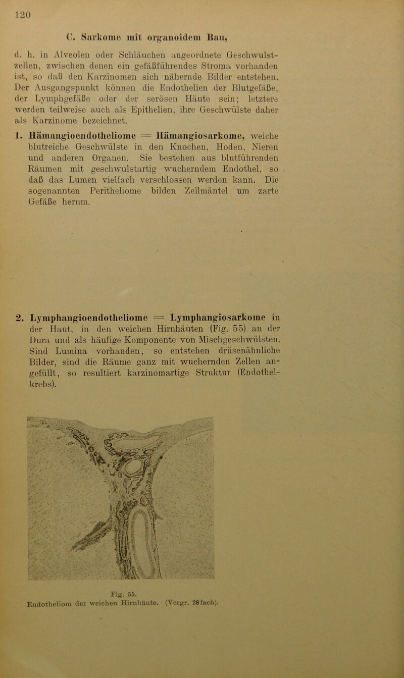0. Sarkome mit organoidem Bau, d. h. in Alveolen oder Schläuchen ungeordnete Geschwulst- zellen, zwischen denen ein gefäßführendes Stroma vorhanden ist, so daß den Karzinomen sich nähernde Bilder entstehen. Der Ausgangspunkt können die Endothelien der Blutgefäße, der Lymphgefäße oder der serösen Häute sein; letztere werden teilweise auch als Epithelien, ihre Geschwülste daher als Karzinome bezeichnet. 1. Hämangioendotheliome = Hämangiosarkome, weiche blutreiche Geschwülste in den Knochen, Hoden, Nieren und anderen Organen. Sie bestehen aus blutführenden Räumen mit geschwulstartig wucherndem Endothel, so . daß das Lumen vielfach verschlossen werden kann. Die sogenannten Peritheliome bilden Zellmäntel um zarte Gefäße herum. 2. Lymphangioendotheliome = Lymphangiosarkome in der Haut, in den weichen Hirnhäuten (Fig. 55) an der Dura und als häufige Komponente von Mischgeschwülsten. Sind Lumina vorhanden, so entstehen drüsenähnliche Bilder, sind die Räume ganz mit wuchernden Zellen an- gefüllt, so resultiert karzinomartige Struktur (Endothel- krebs). Fig. 55. Endotbeliom der weichen Hirnhäute. (Vergr. 28facli).