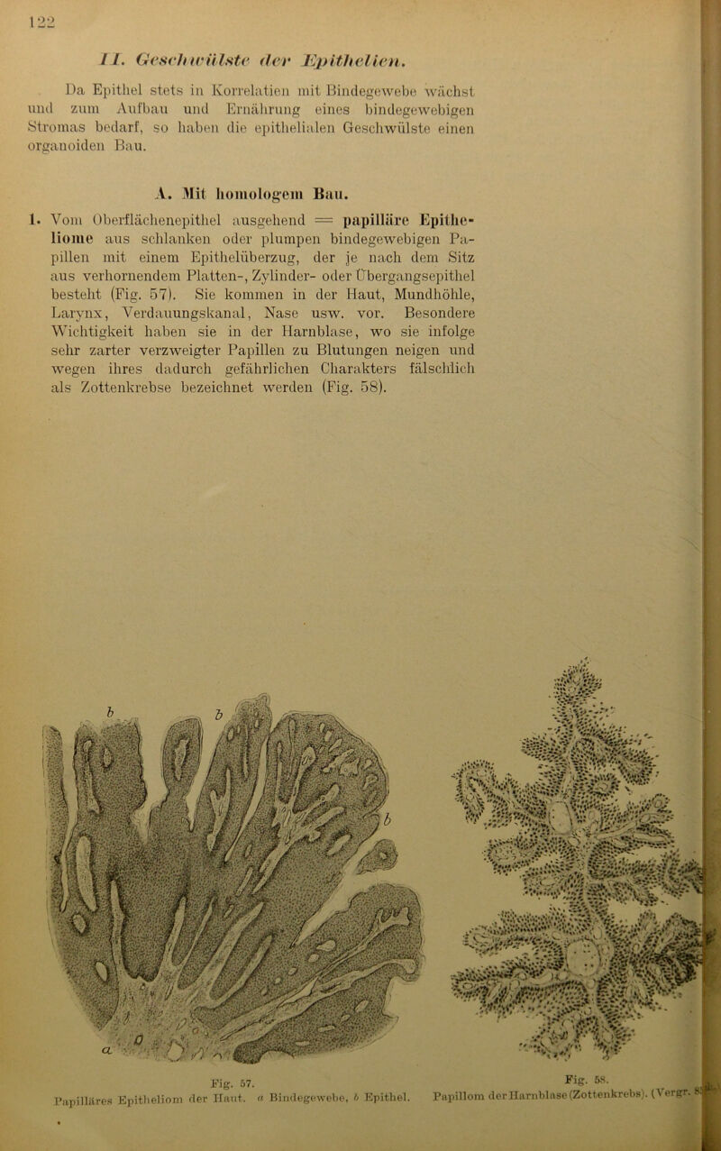 II. Geschwülste der K)) Uh eilen. Da Epithel stets in Korrelation mit Bindegewebe wächst und zum Aufbau und Ernährung eines bindegewebigen Stromas bedarf, so haben die epithelialen Geschwülste einen organoiden Bau. A. Mit homologem Bau. 1. Vom Oberflächenepithel ausgehend = papilläre Epithe- liome aus schlanken oder plumpen bindegewebigen Pa- pillen mit einem Epithelüberzug, der je nach dem Sitz aus verhornendem Platten-, Zylinder- oder Übergangsepithel besteht (Fig. 57). Sie kommen in der Haut, Mundhöhle, Larynx, Verdauungskanal, Nase usw. vor. Besondere Wichtigkeit haben sie in der Harnblase, wo sie infolge sehr zarter verzweigter Papillen zu Blutungen neigen und wegen ihres dadurch gefährlichen Charakters fälschlich als Zottenkrebse bezeichnet werden (Fig. 58). Fig. 57. Papilläres Epitheliom der ITaut. a Bindegewebe, l> Epithel. -a'..'.fis' v<i* msWäjv \v. mm 1 ** V ' ? * ,< »p 11 • * Vl *,'ei „ **,♦•*,\» *»»•*!*« * *»•* !i Vf, # • >i > N»»Vdv (’ 1;>V..•♦ v.sy£ i. 1 * . V'.. %r Fig. 68. Papillom der Harnblase (Zottenkrebs). (Vergr. 8