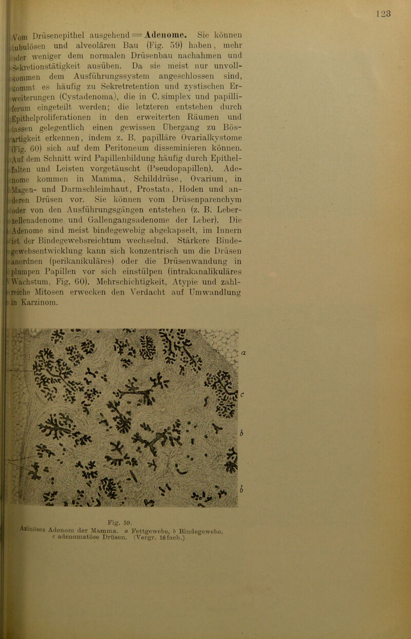 Vom Drüsenepitliel ausgehend = Adenome. Sie können , ubulösen und alveolären Bau (Fig. 59) haben, mehr | xler weniger dem normalen Drüsenbau nachahmen und i Sekretionstätigkeit ausüben. Da sie meist nur unvoll- j kommen dem Ausführungssysteni angeschlossen sind, i kommt es häufig zu Sekretretention und zystischen Er- weiterungen (Cystadenoma), die in C. simplex und papilli- ferum eingeteilt werden; die letzteren entstehen durch Epithelproliferationen in den erweiterten Räumen und lassen gelegentlich einen gewissen Übergang zu Bös- artigkeit erkennen, indem z. B. papilläre Ovarialkystome (Fig. 60) sich auf dem Peritoneum disseminieren können. Auf dem Schnitt wird Papillenbildung häufig durch Epithel- falten und Leisten vorgetäuscht (Pseudopapillen). Ade- nome kommen in Mamma, Schilddrüse, Ovarium, in Magen- und D arm Schleimhaut, Prostata, Hoden und an- deren Drüsen vor. Sie können vom Drüsenparenchym oder von den Ausführungsgängen entstehen (z. B. Leber- zellenadenome und Gallengangsadenome der Leber). Die Adenome sind meist bindegewebig abgekapselt, im Innern ist der Bindegewebsreichtum wechselnd. Stärkere Binde- gewebsentwicklung kann sich konzentrisch um die Drüsen anordnen (perikanikuläres) oder die Drüsenwandung in plumpen Papillen vor sich einstülpen (intrakanalikuläres Wachstum, Fig. 60). Mehrschichtigkeit, Atypie und zahl- reiche Mitosen erwecken den Verdacht auf Umwandlung in Karzinom. Fig. 5!). Azinöses Adenom der Mamma. « Fettgewebe, b Bindegewebe, c adenomatöse Drüsen. (Vergr. 16fach.)