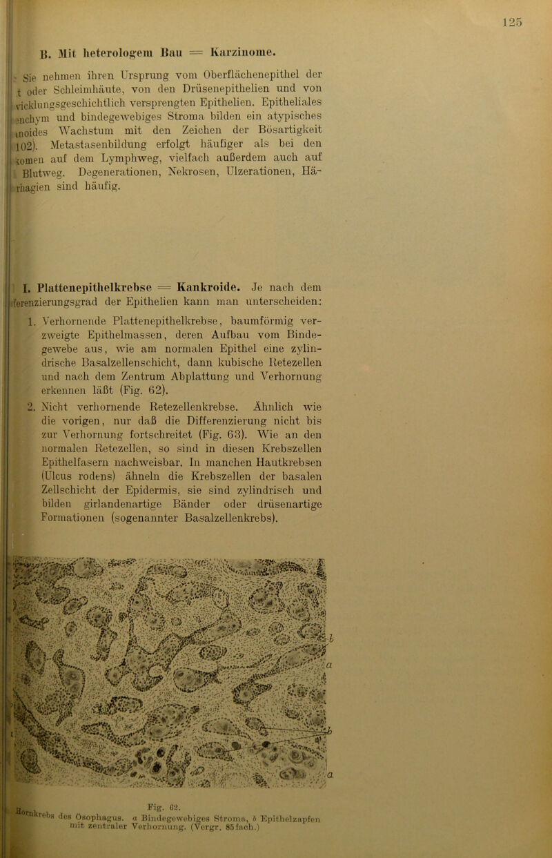 B. Mit lieterologem Bau = Karzinome. L gje nehmen ihren Ursprung vom Oberflächenepithel der ! t oder Schleimhäute, von den Drüsenepithelien und von j vicklungsgescliichtlich versprengten Epithelien. Epitheliales nichym und bindegewebiges Stroma bilden ein atypisches I tnoides Wachstum mit den Zeichen der Bösartigkeit 102). Metastasenbildung erfolgt häufiger als bei den mmen auf dem Lymphweg, vielfach außerdem auch auf ! Blutweg. Degenerationen, Nekrosen, Ulzerationen, Hä- I rhagien sind häufig. I. Blattenepithelkrebse = Kankroide. Je nach dem . ferenzierungsgrad der Epithelien kann man unterscheiden: 1. Verhornende Plattenepithelkrebse, baumförmig ver- zweigte Epithelmassen, deren Aufbau vom Binde- gewebe aus, wie am normalen Epithel eine zylin- drische Basalzellenschicht, dann kubische Retezellen und nach dem Zentrum Abplattung und Verhornung erkennen läßt (Fig. 62). 2. Nicht verhornende Retezellenkrebse. Ähnlich wie die vorigen, nur daß die Differenzierung nicht bis zur Verhornung fortschreitet (Fig. 63). Wie an den normalen Retezellen, so sind in diesen Krebszellen Epithelfasern nachweisbar. In manchen Hautkrebsen (Ulcus rodens) ähneln die Krebszellen der basalen Zellschicht der Epidermis, sie sind zylindrisch und bilden girlandenartige Bänder oder drüsenartige Formationen (sogenannter Basalzellenkrebs). >V,V•*».?&-•' i, ■■ WjkrV.'.; jpfrnkrebs des Ösophagus. mit zentraler Fig. 62. a Bindegewebiges Stroma, b Epithelzapfen Verhornung. (Vergr. 85fach.)