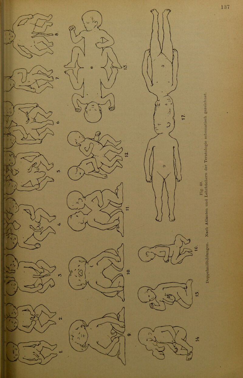 vO Eig. 69. 1) op p elm i ß b ildungen. Nach Atlanten und Lehrbüchern der Teratologie schematisch gezeichnet.