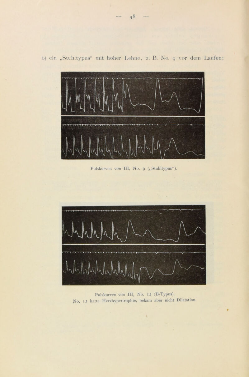 qS b) e’m „StLh’.typus“ mit holier l.ehne, z. B. \o. 9 vor dem J.aiifen; Pulslvurven von III, No. 9 (,,Stuhltypus“)- P Pulskurven von IIT, No. 12 (B-Typus). No. 12 hatte Herzhypertrophie, bekam aber nicht Dilatation.