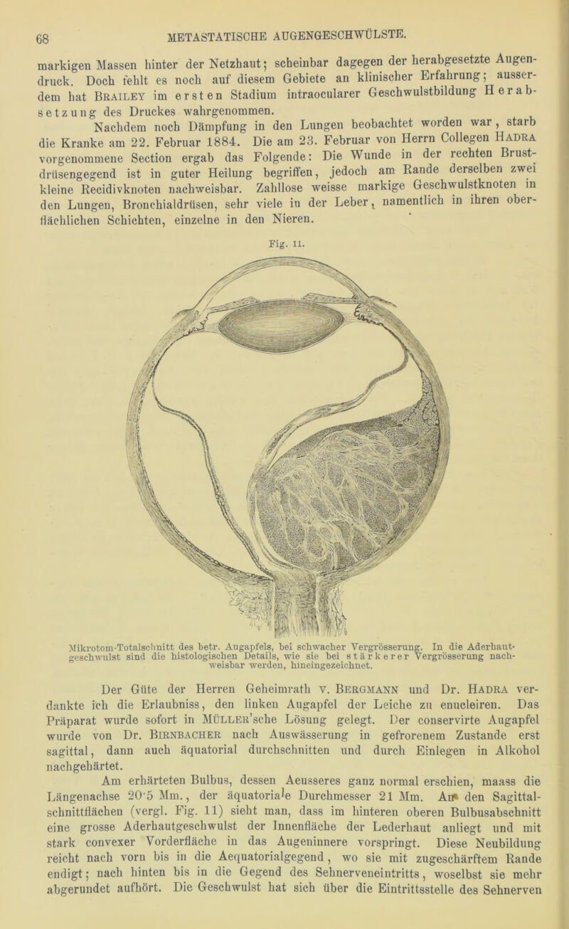 markigen Massen hinter der Netzhaut; scheinbar dagegen der herabgesetzte Augen- druck. Doch fehlt es noch auf diesem Gebiete an klinischer Erfahrung; ausser- dem hat Brailey im ersten Stadium intraocularer Geschwulstbildung Herab- setzung des Druckes wahrgenommen. Nachdem noch Dämpfung in den Lungen beobachtet worden war, staib die Kranke am 22. Februar 1884. Die am 23. Februar von Herrn Collegen Hadra vorgenommene Section ergab das Folgende: Die Wunde in der rechten Brust- drüsengegend ist in guter Heilung begriffen, jedoch am Rande derselben zwei kleine Recidivknoten nachweisbar. Zahllose weisse markige Geschwulstknoten in den Lungen, Bronchialdrüsen, sehr viele in der Leber, namentlich in ihren ober- flächlichen Schichten, einzelne in den Nieren. Fig. 11. iliki’otom-Totalsctmitt des betr. Augapfels, bei schwacher Vergrösserung. In die Aderhaut- geschwulst sind die histologischen Details, wie sie bei stärkerer Vergrösserung nach- “ weisbar werden, hmeingezeichnet. Der Güte der Herren Geheimrath v. Bergmann und Dr. Hadra ver- dankte ich die Erlaubniss, den linken Augapfel der Leiche zu enucleiren. Das Präparat wurde sofort in MÜLLER’sche Lösung gelegt. Der conservirte Augapfel wurde von Dr. Birnbach ER nach Auswässerung in gefrorenem Zustande erst sagittal, dann auch äquatorial durchschnitten und durch Einlegen in Alkohol nachgehärtet. Am erhärteten Bulbus, dessen Aeusseres ganz normal erschien, maass die Längenachse 20‘5 Mm., der äquatoriale Durchmesser 21 Mm. An* den Sagittal- schnittflächen (vergl. Fig. 11) sieht man, dass im hinteren oberen Bulbusabsehnitt eine grosse Aderhautgeschwulst der Innenfläche der Lederhaut anliegt und mit stark convexer Vorderfläche in das Augeninnere vorspringt. Diese Neubildung reicht nach vorn bis in die Aequatorialgegend, wo sie mit zugeschärftem Rande endigt; nach hinten bis in die Gegend des Sehnerveneintritts, woselbst sie mehr abgerundet aufhört. Die Geschwulst hat sich über die Eintrittsstelle des Sehnerven
