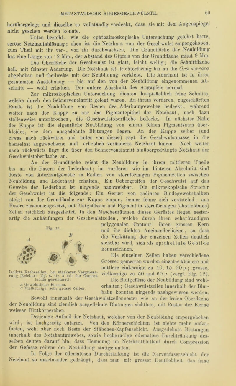 herübergelegt und dieselbe so vollständig verdeckt, dass sie mit dem Augenspiegel nicht gesehen werden konnte. Unten besteht, wie die ophthalmoskopische Untersuchung gelehrt hatte. seröse Netzhautablösung; oben ist die Netzhaut von der Geschwulst emporgehoben, zum Theil mit ihr ver-, von ihr durchwachsen. Die Grundfläche der Neubildung hat eine Länge von 1 2 Mm., der Abstand des Gipfels von der Grundfläche misst 9 Mm. Die Oberfläche der Geschwulst ist glatt, leicht wellig; die Schnittfläche hell, mit feinster Aederung. Die Netzhaut ist trichterförmig bis an die Ora serrata abgehoben und theilweise mit der Neubildung verklebt. Die Aderhaut ist in ihrer gesammten Ausdehnung — bis auf den von der NeubiMung eingenommenen Ab- schnitt — wohl erhalten. Der untere Abschnitt des Augapfels normal. Zur mikroskopischen Untersuchung dienten hauptsächlich feine Schnitte, welche durch den Sehnerveneintritt gelegt waren. An ihrem vorderen, zugeschärften Rande ist die Neubildung von Resten des Aderhautgewebes bedeckt, während weiter nach der Kuppe zu nur das Pigmentepithel der Netzhaut, noch dazu stellenweise unterbrochen, die Geschwulstoberfläche bedeckt. In nächster Nähe der Kuppe ist die eigentliche Neubildung von einem feinen Pigmentsaum über- kleidet, vor dem ausgedehnte Blutungen liegen. An der Kuppe selber (und etwas nach rückwärts und unten von dieser) ragt die Geschwulstmasse in die hierselbst angewachsene und erheblich veränderte Netzhaut hinein. Noch weiter nach rückwärts liegt die über den Sehnerveneintritt hinübergedrängte Netzhaut der Geschwulstoberfläche an. An der Grundfläche reicht die Neubildung in ihrem mittleren Theile Reste von Aderhautgewebe in Reihen von sternförmigen Pigmentzellen zwischen Neubildung und Lederhaut erhalten.. Ein Uebergreifen der Geschwulst auf das Gewebe der Lederhaut ist nirgends nachweisbar. Die mikroskopische Structur der Geschwulst ist die folgende: Ein Gerüst von radiären Bindegewebsbalken steigt von der Grundfläche zur Kuppe empor, immer feiner sich verästelnd, aus Fasern zusammengesetzt, mit Blutgefässen und Pigment in sternförmigen (chorioidalen) Zellen reichlich ausgestattet. In den Maschenräumen dieses Gerüstes liegen nester- artig die Anhäufungen der Geschwulstzellen, welche durch ihren scharfrandigen Sowohl innerhalb der Geschwulstzellennester wie an der freien Oberfläche der Neubildung sind ziemlich ausgedehnte Blutungen sichtbar, mit Resten der Kerne weisser Blutkörperchen. Derjenige Antheil der Netzhaut, welcher von der Neubildung emporgehoben wird, ist hochgradig entartet. Von den Körnerschichten ist nichts mehr aufzu- finden, wohl aber noch Reste der Stäbchen-Zapfenscbicht. Ausgedehnte Blutungen innerhalb des Netzhautgewebes, sowie hochgradige ödcmatöse Durchtränkung des- selben deuten darauf hin, dass Hemmung im Netzhautblutlauf durch Compression der Gefässe seitens der Neubildung stattgefunden. In Folge der ödematösen Durchträukung ist die Nervenfaserschicht der Netzhaut so auseinander gedrängt, dass man mit grosser Deutlichkeit das feine bis an die Fasern der Lederhaut; im vorderen wie im hinteren Abschnitt sind A Fig. 12. B polygonalen Contour, ihren grossen Kern und ihr dichtes Aneinanderliegen, so dass die Verkittung der einzelnen Zellen deutlich sichtbar wird, sich als epitheliale Gebilde kennzeichnen. Die einzelnen Zellen haben verschiedene Grösse: gemessen wurden einzelne kleinere und mittlere einkernige zu 10, 15, 20 y.; grosse. erhalten ; Geschwulstzelleu innerhalb der Blut- bahn konnten nirgends nachgewiesen werden.