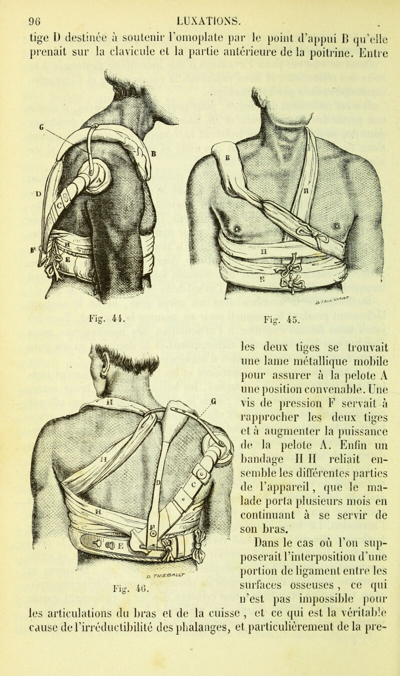 tige D destinée à soutenir l’omoplate par le point d’appui B qu’elle prenait sur la clavicule et la partie antérieure de la poitrine. Entre les deux tiges se trouvait une lame métallique mobile pour assurer à la pelote A une position convenable. Une vis de pression F servait à rapprocher les deux tiges et à augmenter la puissance de la pelote A. Enfin un bandage H H reliait en- semble les différentes parties de l’appareil, que le ma- lade porta plusieurs mois en continuant à se servir de son bras. Dans le cas où l’on sup- poserait l’interposition d’une portion de ligament entre les surfaces osseuses, ce qui n’est pas impossible pour les articulations du bras et de la cuisse , et ce qui est la véritable cause de l’irréductibilité des phalanges, et particulièrement delà pre-
