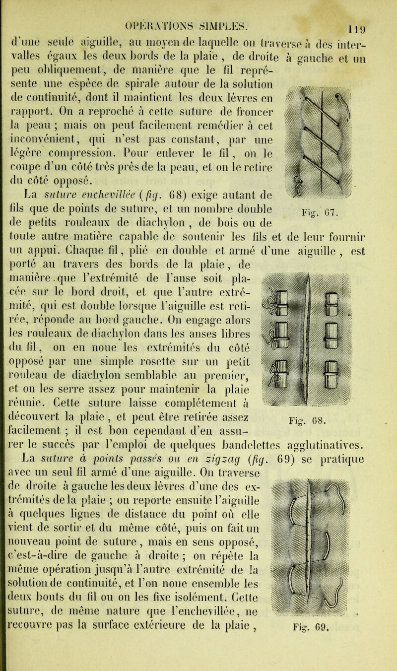 d’iine seule aiguille, au moyeu de laquelle ou traverse à des inter- valles égaux les deux bords de la plaie , de droite à gauche et un peu obliquement, de manière que le til repré- sente une espèce de. spirale autour de la solution de continuité, dont il maintient les deux lèvres en rapport. On a reproché à cette suture de froncer la peau ; mais on peut facilement remédier à cet inconvénient, qui n’est pas constant, par une légère compression. Pour enlever le fil, on le coupe d’un côté très près de la peau, et on le retire du côté opposé. La suture enchevillée (fig. 6<S) exige autant de fils que de points de suture, et un nombre double de petits rouleaux de diacbylon , de bois ou de toute autre matière capable de soutenir les fils et de leur fournir un appui. Chaque fil, plié en double et armé d’une aiguille , est porté au travers des bords de la plaie, de manière.que l’extrémité de l’anse soit pla- cée sur le bord droit, et que l’autre extré- mité, qui est double lorsque l’aiguille est reti- rée, réponde au bord gauche. On engage alors les rouleaux de diacbylon dans les anses libres du fil, on en noue les extrémités du côté opposé par une simple rosette sur un petit rouleau de diacbylon semblable au premier, et on les serre assez pour maintenir la plaie réunie. Cette suture laisse complètement à découvert la plaie , et peut être retirée assez facilement ; il est bon cependant d’en assu- rer le succès par l’emploi de quelques bandelettes agglutinatives. La suture à points passés ou en zigzag (fig. 69) se pratique avec un seul fil armé d’une aiguille. On traverse de droite à gauche les deux lèvres d’une des ex- trémités delà plaie ; on reporte ensuite l’aiguille à quelques lignes de distance du point où elle vient de sortir et du même côté, puis on fait un nouveau point de suture, mais en sens opposé, c’est-à-dire de gauche à droite ; on répète la même opération jusqu’à l’autre extrémité de la solution de continuité, et l’on noue ensemble les deux bouts du fd ou on les fixe isolément. Cette suture, de même nature que rencbevillée, ne recouvre pas la surface extérieure de la plaie , Fig, 69.