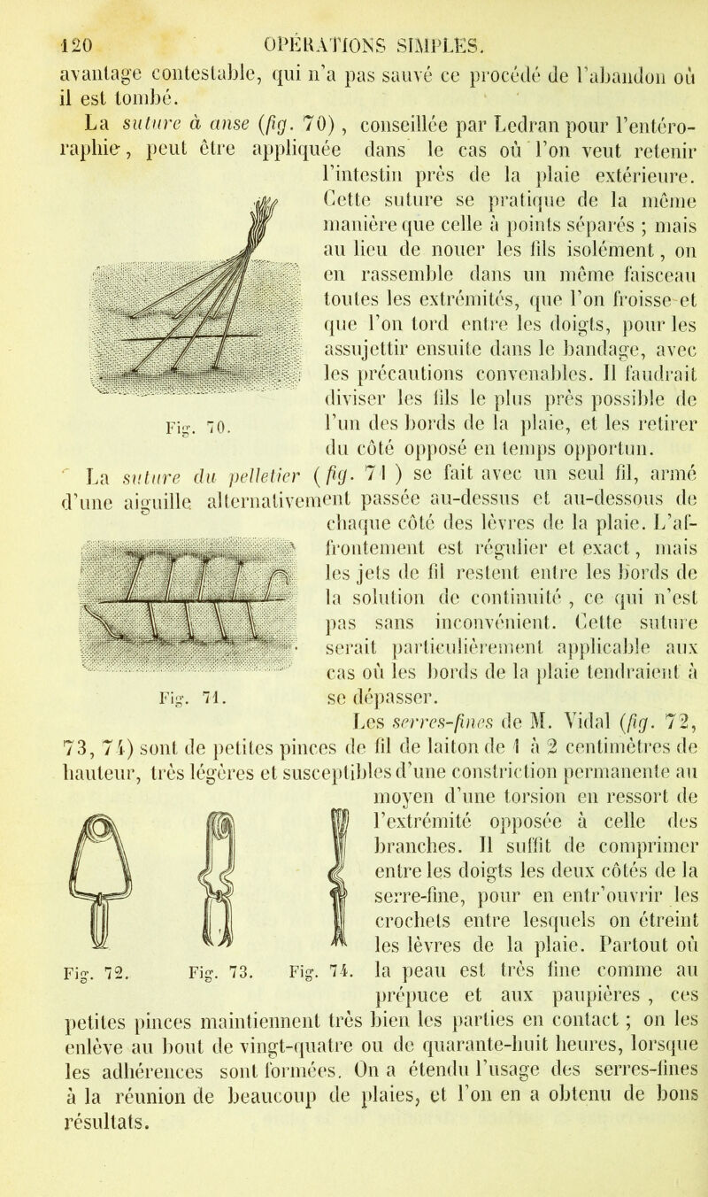 avantage contestable, qui n’a pas sauvé ce procédé de rabandon ou il est tombé. La suture à anse {/ig. 70), conseillée par Ledran pour Pentéro- rapliie, peut être appliquée dans le cas où l’on veut retenir rintestin près de la plaie extérieure. Cette suture se pratique de la même manière que celle à points séparés ; mais au lieu de nouer les lils isolément, on en rassemble dans un même faisceau toutes les extrémités, que l’on froisse et que l’on tord entre les doigts, pour les assujettir ensuite dans le bandage, avec les précautions convenables. Il faudrait diviser les lils le plus près possible de l’un des bords de la plaie, et les retirer du côté opposé en temps opportun. La suture du pelletier {fig> 71 ) se fait avec un seul fd, armé d’une aiguille, alternativement passée au-dessus et au-dessous de chaque côté des lèvres de la plaie. L’af- frontement est régulier et exact, mais les jets de fil restent entre les bords de la solution de continuité , ce qui n’est pas sans inconvénient. Cette suture serait particulièrement applicable aux cas où les l)ords de la jdaie tendraient à Fig-. 71. se dépasser. Les serres-fuies de M. Vidal {fîg. 72, 73, 74) sont de petites pinces de fil de laiton de 1 à 2 centimètres de hauteur, très légères et susceptibles d’une constriction permanente au moyen d’une torsion en ressort de l’extrémité opposée à celle des branches. Il suffit de comprimer entre les doigts les deux côtés de la serre-fine, pour en entr’ouvrir les crochets entre lesquels on étreint les lèvres de la plaie. Partout où Fig. 72. Fig. 73. Fig. 74. la peau est très line comme au prépuce et aux paupières , ces jietites pinces maintiennent très bien les parties en contact ; on les enlève au bout de vingt-quatre ou de quarante-huit heures, lorsque les adhérences sont formées. On a étendu l’usage des serres-tines à la réunion de beaucoup de plaies, et l’on en a obtenu de bons résultats.