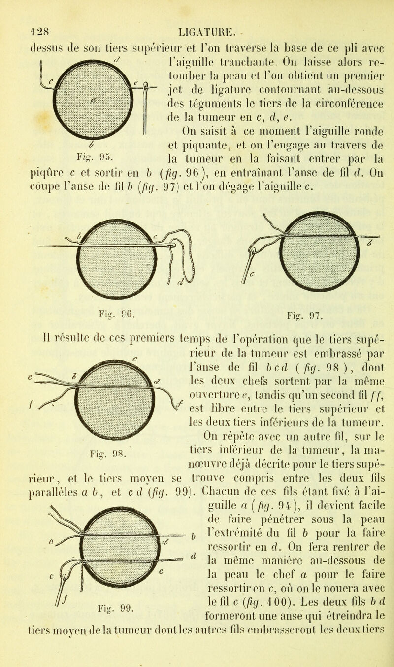 dessus de son tiers supérieur et l’on traverse la base de ce pli avec l’aiguille trancliante. On laisse alors re- tomber la peau et l’on obtient un premier jet de ligature contournant au-dessous des téguments le tiers de la circonférence de la tumeur en c, cl, e. On saisit à ce moment l’aiguille ronde et piquante, et on l’engage au travers de la tumeur en la faisant entrer par la piqûre c et sortir en h (fig. 96), en entraînant l’anse de fil d. On coupe l’anse de fil b [fig. 97) et l’on dégage l’aiguille c. Fig. 97. Il résulte de ces premiers temps de l’opération que le tiers supé- rieur de la tumeur est embrassé par l’anse de fil hcd {fig. 98), dont les deux chefs sortent par la même ouvertures, tandis qu’un second fil ff, est libre entre le tiers supérieur et les deux tiers inférieurs de la tumeur. On répète avec un autre fil, sur le tiers inférieur de la tumeur, la ma- nœuvre déjà décrite pour le tiers supé- rieur , et le tiers moyen se trouve compris entre les deux fils parallèles ah, et c d {fig. 99). Chacun de ces fils étant fixé à l’ai- guille a {fig. 94), il devient facile de faire pénétrer sous la peau ^ l’exti'émité du fil b pour la faire ressortir en cl. On fera rentrer de ^ la même manière au-dessous de la peau le chef a pour le faire ressortir en c, où on le nouera avec le fil c {fig. 100). Les deux fils b d formeront une anse qui étreindra le tiers moyen delà tumeur dont les autres fils embrasseront les deux (iers