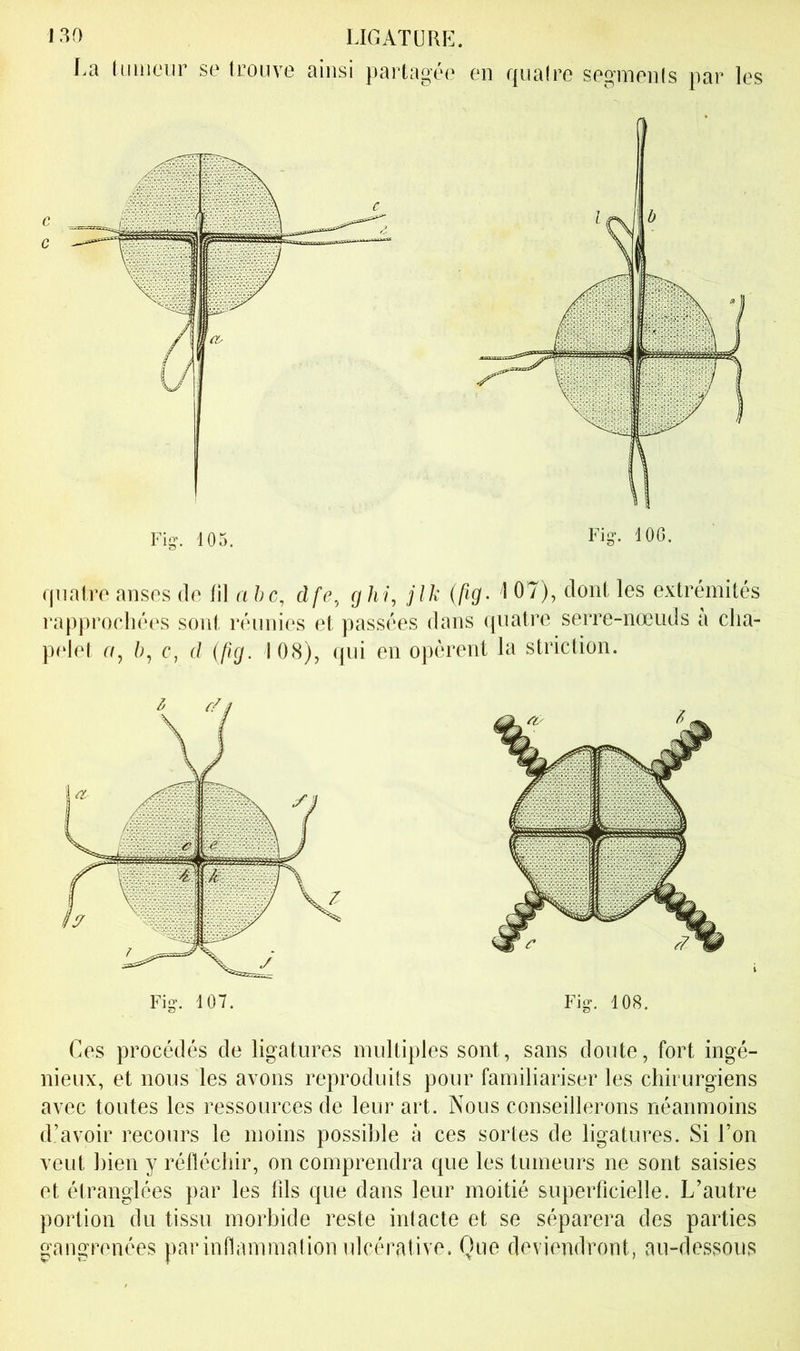 La tiimeor se trouve ainsi partagée en qnaire segments par les quatre anses de til a hc, dfe, ghi, jlk (fig. 1 07), dont les extrémités ]*approcliées sont réunies et passées dans c[iiatre serre-nœuds a clia- p(‘let O, r, d (fig. 108), qui en opèrent la striction. Fig. 107. Fig. 108. Ces procédés de ligatures multiples sont, sans doute, fort ingé- nieux, et nous les avons reproduits pour familiariser les chirurgiens avec toutes les ressources de leur art. Nous conseillerons néanmoins d’avoir recours le moins possible à ces sortes de ligatures. Si l’on veut bien y réfléchir, on comprendra que les tumeurs ne sont saisies et étranglées par les lîls que dans leur moitié superficielle. L’autre portion du tissu morbide reste intacte et se séparera des parties gangrenées par inflammation ulcérative. Que deviendront, au-dessous