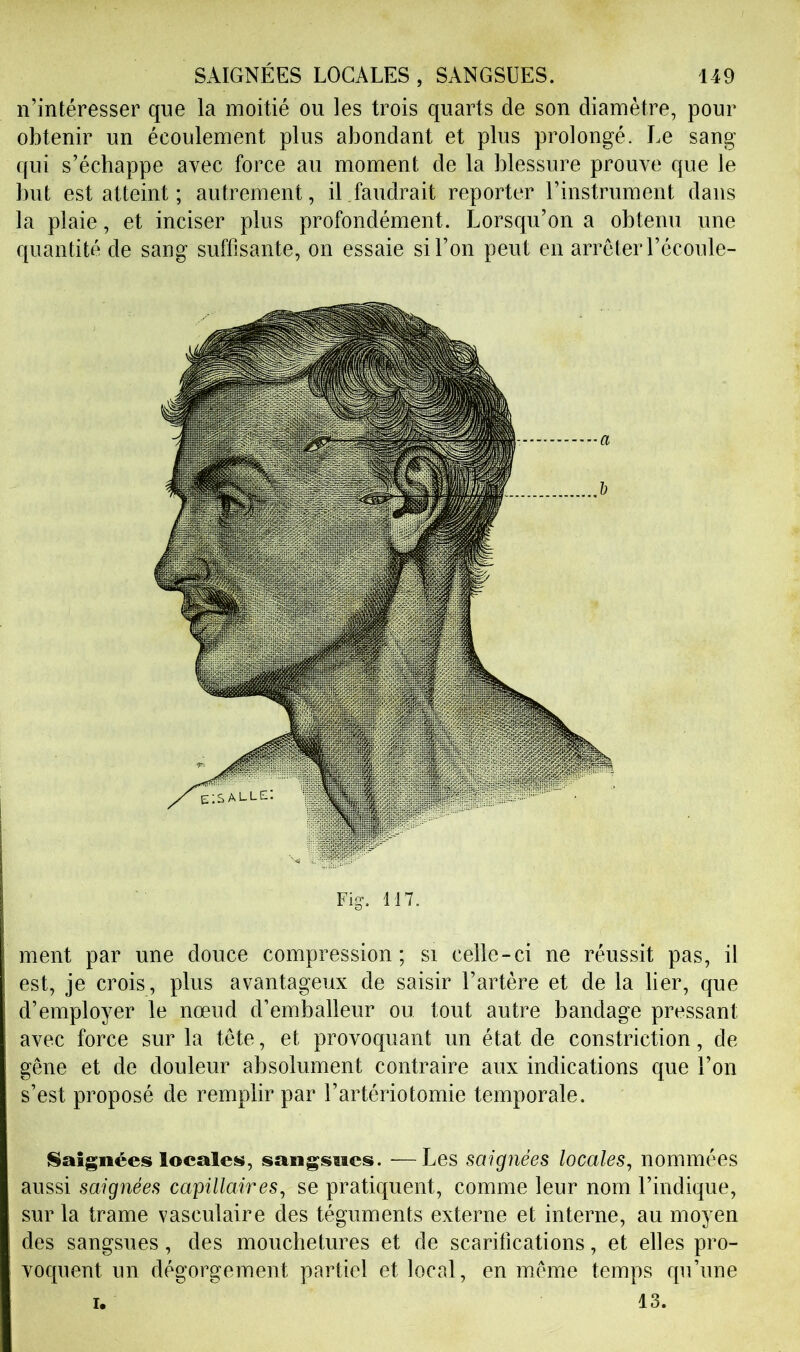 n’intéresser que la moitié ou les trois quarts de son diamètre, pour obtenir un écoulement plus abondant et plus prolongé. Le sang qui s’échappe avec force au moment de la blessure prouve que le but est atteint ; autrement, il.faudrait reporter l’instrument dans la plaie, et inciser plus profondément. Lorsqu’on a obtenu une quantité de sang suffisante, on essaie si l’on peut en arrêter l’écoule- Fig. 117. ment par une douce compression; si celle-ci ne réussit pas, il est, je crois, plus avantageux de saisir l’artère et de la lier, que d’employer le nœud d’emballeur ou tout autre bandage pressant avec force sur la tête, et provoquant un état de constriction, de gêne et de douleur absolument contraire aux indications que l’on s’est proposé de remplir par l’artériotomie temporale. (Saignées locales, sangsues. -—Les saignées locales, nommées aussi saignées capillaires, se pratiquent, comme leur nom l’indique, sur la trame vasculaire des téguments externe et interne, au moyen des sangsues, des mouchetures et de scarifications, et elles pro- voquent un dégorgement partiel et local, en même temps qu’une 13. I.