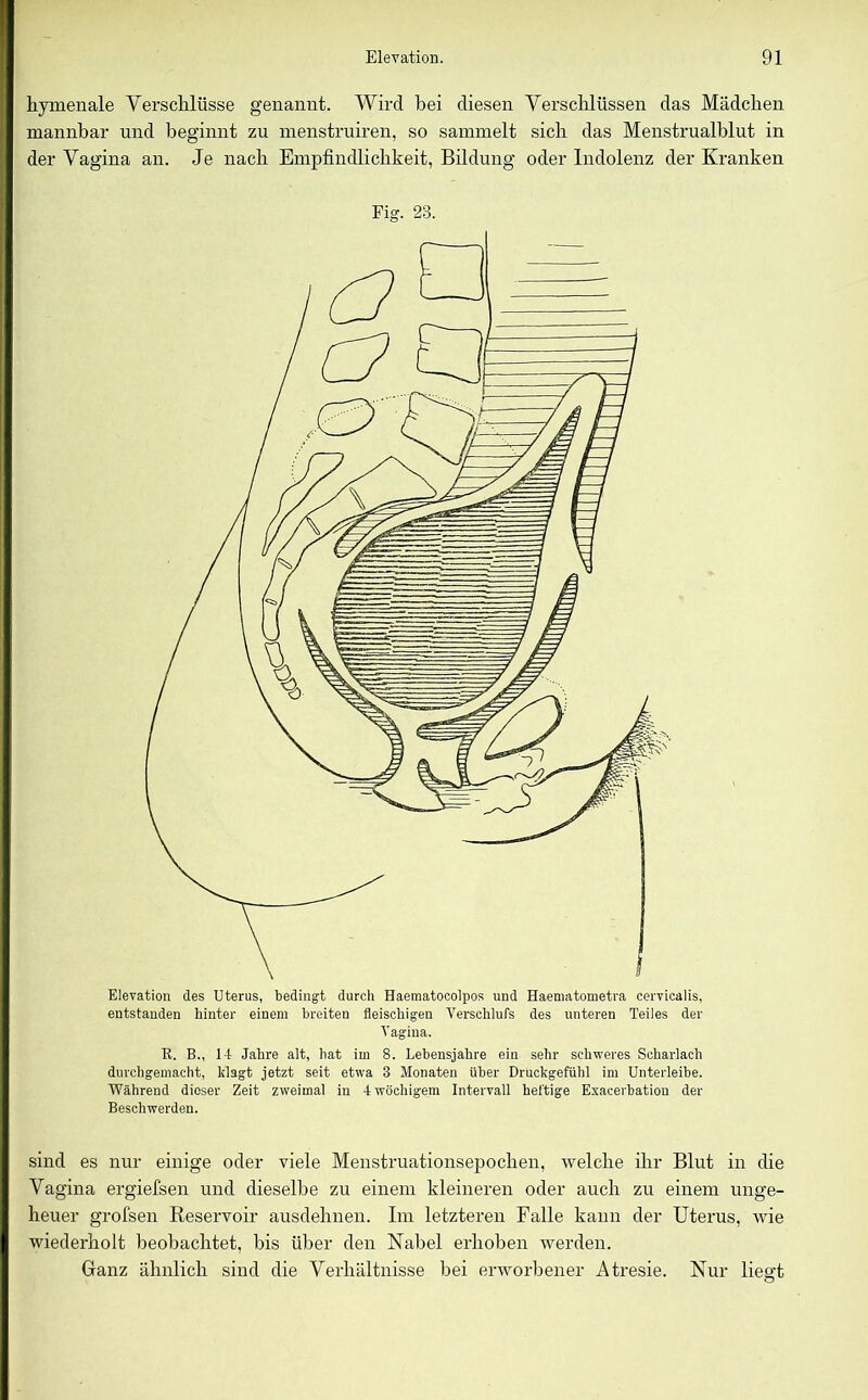 hymenale Yersclilüsse genannt. Wird bei diesen Verschlüssen das Mädchen mannbar und beginnt zu menstruiren, so sammelt sich das Menstrualblut in der Vagina an. Je nach Empfindlichkeit, Bildung oder Indolenz der Kranken Fig. 28. Elevation des Uterus, bedingt durch Haematocolpos und Haematometra cervicalis, entstanden hinter einem breiten fleischigen Verschlufs des unteren Teiles der Vagina. R. B., 14 Jahre alt, hat im 8. Lebensjahre ein sehr schweres Scharlach durchgemacht, klagt jetzt seit etwa 3 Monaten über Druckgefühl im Unterleibe. Während dieser Zeit zweimal in 4 wöchigem Intervall heftige Exacerbation der Beschwerden. sind es nur einige oder viele Menstruationsepochen, welche ihr Blut in die Vagina ergiefsen und dieselbe zu einem kleineren oder auch zu einem unge- heuer grofsen Reservoir ausdehnen. Im letzteren Falle kann der Uterus, wie wiederholt beobachtet, bis über den Nabel erhoben werden. Ganz ähnlich sind die Verhältnisse bei erworbener Atresie. Nur liegt