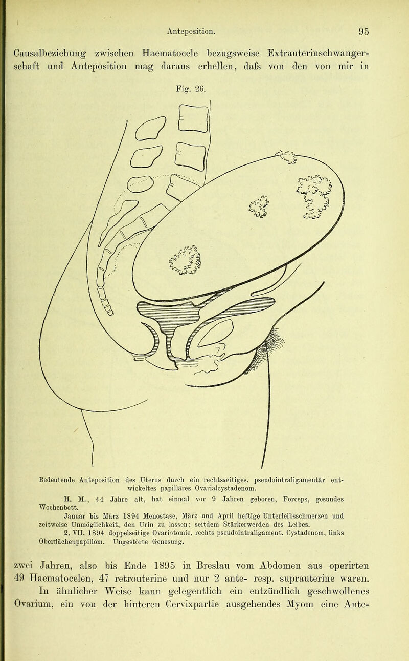 Causalbezieliung zwischen Haematocele bezugsweise Extrauterinschwanger- schaft und Anteposition mag daraus erhellen, dafs von den von mir in Fig. 26. H. M., 44 Jahre alt, hat einmal vor 9 Jahren gehören, Forceps, gesundes Wochenbett. Januar bis März 1894 Menostase, März und April heftige Unterleibsschmerzen und zeitweise Unmöglichkeit, den Urin zu lassen; seitdem Stärkerwerden des Leibes. 2. VII. 1894 doppelseitige Ovariotomie, rechts pseudointraligament. Cystadenom, links Oberflächenpapillom. Ungestörte Genesung. zwei Jahren, also bis Ende 1895 in Breslau vom Abdomen aus operirten 49 Haematocelen, 47 retrouterine und nur 2 ante- resp. suprauterine waren. In ähnlicher Weise kann gelegentlich ein entzündlich geschwollenes Ovarium, ein von der hinteren Cervixpartie ausgehendes Myom eine Ante-