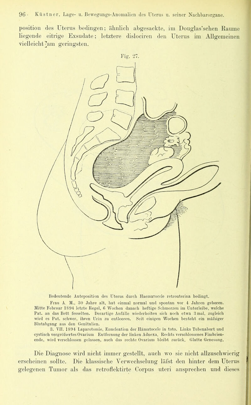 Position des Uterus bedingen; ähnlich abgesackte, im Douglas’schen Raume liegende eitrige Exsudate; letztere dislociren den Uterus im Allgemeinen vielleicht -am geringsten. Fig. 27. Bedeutende Anteposition des Uterus durch Haematocele retrouterina bedingt. Frau A. M., 30 Jahre alt, hat einmal normal und spontan vor 4 Jahren geboren. Mitte Februar 1894 letzte Regel, fi Wochen danach heftige Schmerzen im Uuterleihe, welche Pat. an das Bett fesselten. Derartige Anfälle wiederholten sich noch etwa 3 mal, zugleich wird es Pat. schwer, ihren Urin zu entleeren. Seit einigen Wochen besteht ein mäfsiger Blutabgang aus den Genitalien. 3. VIT. 1894 Laparotomie, Enucleation der Hämatocele in toto. Links Tubenabort und cystisch vergröfsertes Ovarium Entfernung der linken Adnexa. Rechts verschlossenes Fimbrien- ende, wird verschlossen gelassen, auch das rechte Ovarium bleibt zurück. Glatte Genesung. Die Diagnose wird nicht immer gestellt, auch wo sie nicht allzuschwierig erscheinen sollte. Die klassische Verwechselung läfst den hinter dem Uterus gelegenen Tumor als das retroflektirte Corpus uteri ansprechen und dieses