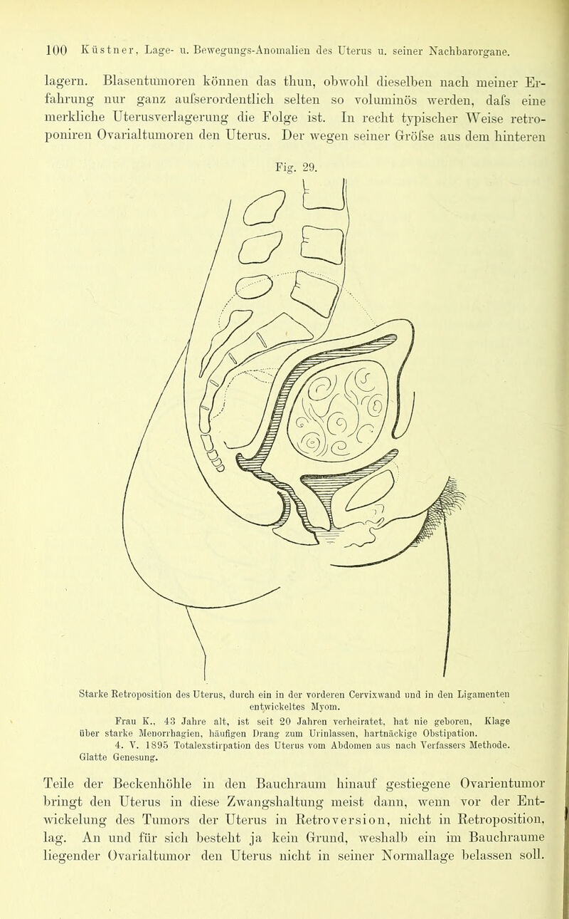 lagern. Blasentumoren können das tliun, obwohl dieselben nach meiner Er- fahrung nur ganz aufserordentlich selten so voluminös werden, dafs eine merkliche Uterusverlagerung die Folge ist. In recht typischer Weise retro- poniren Ovarialtumoren den Uterus. Der wegen seiner Gröfse aus dem hinteren Fig. 29. Starke Retroposition des Uterus, durch ein in der vorderen Cervixwand und in den Ligamenten entwickeltes Myom. Frau IC.. 43 Jahre alt, ist seit 20 Jahren verheiratet, hat nie gehören, Klage über starke Menorrhagien, häufigen Drang zum Urinlassen, hartnäckige Obstipation. 4. V. 1895 Totalexstirpation des Uterus vom Abdomen aus nach Verfassers Methode. Glatte Genesung. Teile der Beckenhöhle in den Bauchraum hinauf gestiegene Ovarientumor bringt den Uterus in diese Zwangshaltung meist dann, wenn vor der Ent- wickelung des Tumors der Uterus in Retroversion, nicht in Retroposition. lag. An und für sich besteht ja kein Grund, weshalb ein im Bauchraume liegender Ovarialtumor den Uterus nicht in seiner Normallage belassen soll.