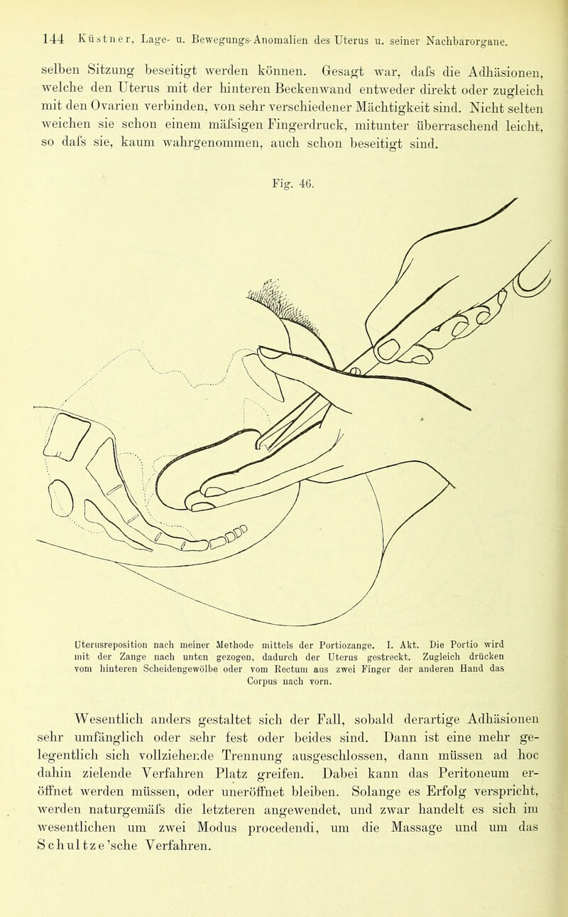 selben Sitzung beseitigt werden können. Gesagt war, dafs die Adhäsionen, welche den Uterus mit der hinteren Beckenwand entweder direkt oder zugleich mit den Ovarien verbinden, von sehr verschiedener Mächtigkeit sind. Nicht selten weichen sie schon einem mäfsigen Fingerdruck, mitunter überraschend leicht, so dafs sie, kaum wahrgenommen, auch schon beseitigt sind. Fig. 46. Uterusreposition nach meiner Methode mittels der Portiozange. I. Akt. Die Portio wird mit der Zange nach unten gezogen, dadurch der Uterus gestreckt. Zugleich drücken vom hinteren Scheidengewölbe oder vom Rectum aus zwei Finger der anderen Hand das Corpus nach vorn. Wesentlich anders gestaltet sich der Fall, sobald derartige Adhäsionen sehr umfänglich oder sehr fest oder beides sind. Dann ist eine mehr ge- legentlich sich vollziehende Trennung ausgeschlossen, dann müssen ad hoc dahin zielende Verfahren Platz greifen. Dabei kann das Peritoneum er- öffnet werden müssen, oder uneröffnet bleiben. Solange es Erfolg verspricht, werden natnrgemäfs die letzteren angewendet, und zwar handelt es sich im wesentlichen um zwei Modus procedendi, um die Massage und um das Schultze’sche Verfahren.