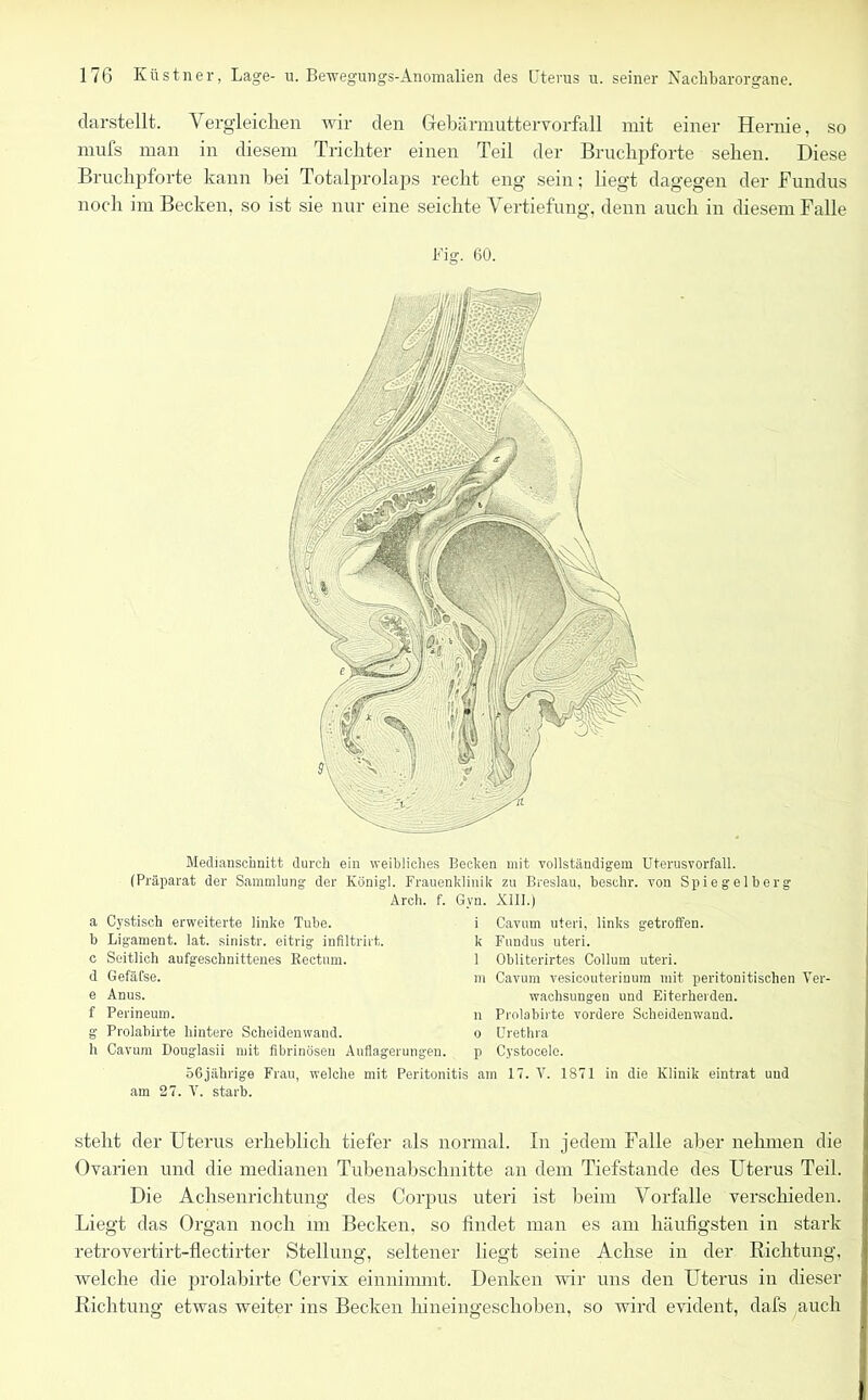 darstellt. Vergleichen wir den Grebärmuttervorfall mit einer Hernie, so mufs man in diesem Trichter einen Teil der Bruchpforte sehen. Diese Bruchpforte kann bei Totalprolaps recht eng sein; liegt dagegen der Fundus noch im Becken, so ist sie nur eine seichte Vertiefung, denn auch in diesem Falle Fig. 60. Medianschnitt durch ein weibliches Bechen mit vollständigem Uterusvorfall. (Präparat der Sammlung der Königl. Frauenklinik zu Breslau, beschr. von Spiegelberg Arch. f. a Cystisch erweiterte linke Tube, b Ligament, lat. sinistr. eitrig infiltrirt. c Seitlich aufgeschnittenes Rectum, d GefäCse. e Anus, f Perineum. g Prolabirte hintere Scheidenwand, h Cavum Douglasii mit fibrinöseu Auflagerungen Gyn. XIII.) i Cavum uteri, links getroffen, k Fundus uteri. 1 Obliterirtes Collum uteri. m Cavum vesicouterinum mit peritonitischen Ver- wachsungen und Eiterherden, n Prolabirte vordere Scheidenwand, o Urethra p Cystocelc. 56jährige Frau, welche mit Peritonitis am 17. V. 1871 in die Klinik eintrat und am 27. V. starb. steht der Uterus erheblich tiefer als normal. In jedem Falle aber nehmen die Ovarien und die medianen Tubenabschnitte an dem Tiefstände des Uterus Teil. Die Achsenrichtung des Corpus uteri ist beim Vorfälle verschieden. Liegt das Organ noch im Becken, so findet man es am häufigsten in stark retrovertirt-flectirter Stellung, seltener liegt seine Achse in der Richtung, welche die prolabirte Cervix einnimmt. Denken wir uns den Uterus in dieser Richtung etwas weiter ins Becken hineingeschoben, so wird evident, dafs auch
