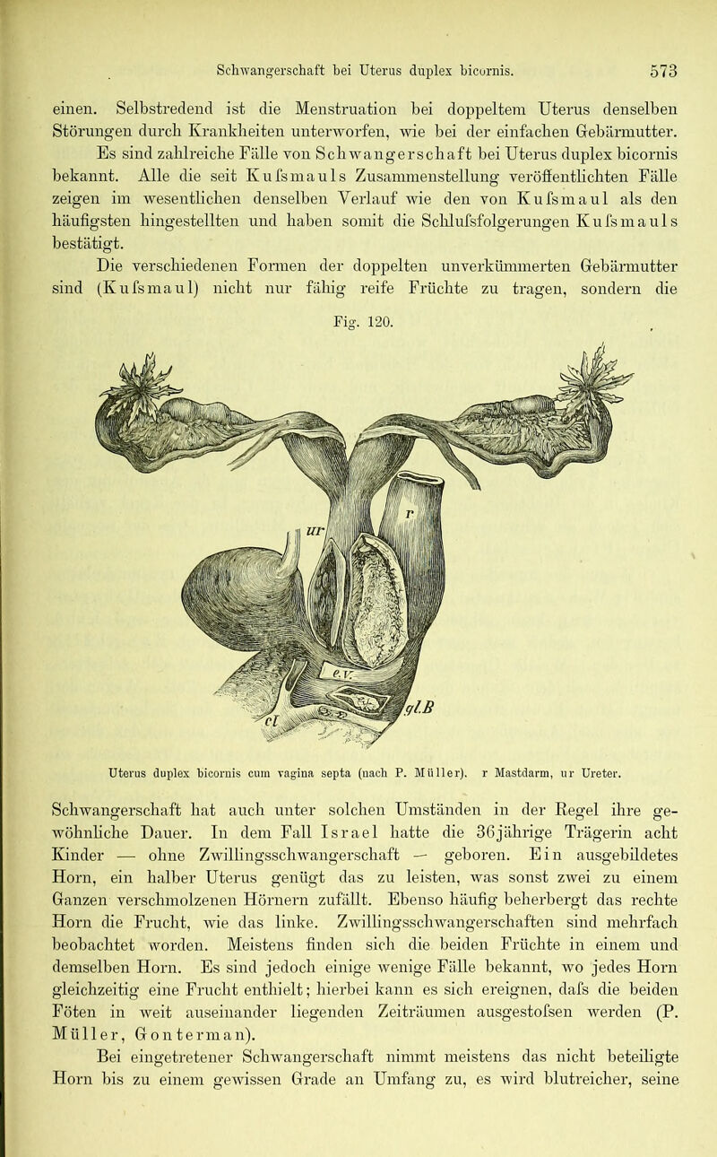 einen. Selbstredend ist die Menstruation bei doppeltem Uterus denselben Störungen durch Krankheiten unterworfen, wie bei der einfachen Gebärmutter. Es sind zahlreiche Fälle toii Schwangerschaft bei Uterus duplex bicornis bekannt. Alle die seit Kufsmauls Zusammenstellung veröffentlichten Fälle zeigen im wesentlichen denselben Verlauf wie den von Kufsmaul als den häufigsten hingestellten und haben somit die Schlufsfolgerungen Kufsmauls bestätigt. Die verschiedenen Formen der doppelten unverkümmerten Gebärmutter sind (Kufsmaul) nicht nur fähig reife Früchte zu tragen, sondern die Fig. 120. Uterus duplex bicornis cum vagina septa (uacli P. Müller), r Mastdarm, ur Ureter. Schwangerschaft hat auch unter solchen Umständen in der Regel ihre ge- wöhnliche Dauer. In dem Fall Israel hatte die 36jährige Trägerin acht Kinder — ohne Zwillingsschwangerschaft — geboren. Ein ausgebildetes Horn, ein halber Uterus genügt das zu leisten, was sonst zwei zu einem Ganzen verschmolzenen Hörnern zufällt. Ebenso häufig beherbergt das rechte Horn die Frucht, wie das linke. Zwillingsschwangerschaften sind mehrfach beobachtet worden. Meistens finden sich die beiden Früchte in einem und demselben Horn. Es sind jedoch einige wenige Fülle bekannt, wo jedes Horn gleichzeitig eine Frucht enthielt; hierbei kann es sich ereignen, dafs die beiden Föten in weit auseinander liegenden Zeiträumen ausgestofsen werden (P. Müller, Gonterman). Bei eingetretener Schwangerschaft nimmt meistens das nicht beteiligte Horn bis zu einem gewissen Grade an Umfang zu, es wird blutreicher, seine