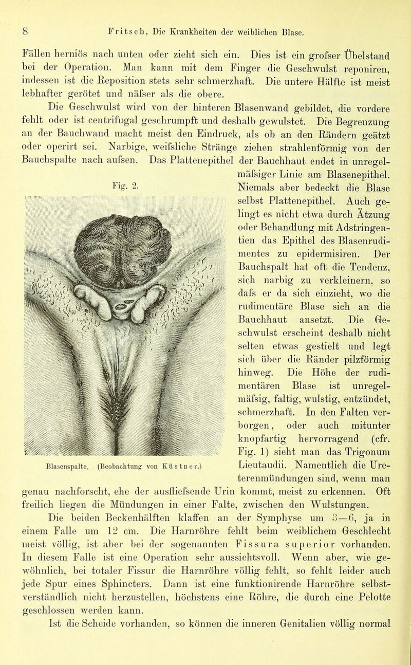 Fällen herniös nach unten oder zieht sich ein. Dies ist ein grofser Übelstand bei der Operation. Man kann mit dem Finger die Geschwulst reponiren, indessen ist che Reposition stets sehr schmerzhaft. Die untere Hälfte ist meist lebhafter gerötet und näfser als die obere. Die Geschwulst wird von der hinteren Blasenwand gebildet, die vordere fehlt oder ist centrifugal geschrumpft und deshalb gewulstet. Die Begrenzung an der Bauchwand macht meist den Eindruck, als ob an den Rändern geätzt oder operirt sei. Narbige, weifsliche Stränge ziehen strahlenförmig von der Bauchspalte nach aufsen. Das Plattenepithel der Bauchhaut endet in unregel- mäfsiger Linie am Blasenepithel. Niemals aber bedeckt die Blase selbst Plattenepithel. Auch ge- lingt es nicht etwa durch Ätzung oder Behandlung mit Adstringen- tien das Epithel des Blasenrudi- mentes zu epidermisiren. Der Bauchspalt hat oft die Tendenz, sich narbig zu verkleinern, so dafs er da sich einzieht, wo die rudimentäre Blase sich an die Bauchhaut ansetzt. Die Ge- schwulst erscheint deshalb nicht selten etwas gestielt und legt sich über die Ränder pilzförmig hinweg. Die Höhe der rudi- mentären Blase ist unregel- mäfsig, faltig, wulstig, entzündet, schmerzhaft. In den Falten ver- borgen , oder auch mitunter knopfartig hervorragend (cfr. Fig. 1) sieht man das Trigonum Lieutaudii. Namentlich die Ure- terenmündungen sind, wenn man genau nachforscht, ehe der ausfliefsende Urin kommt, meist zu erkennen. Oft freilich liegen die Mündungen in einer Falte, zwischen den Wulstungen. Die beiden Beckenhälften klaffen an der Symphyse um 3 — 6, ja in einem Falle um 12 cm. Die Harnröhre fehlt beim weiblichem Geschlecht meist völlig, ist aber bei der sogenannten Fissura superior vorhanden. In diesem Falle ist eine Operation sehr aussichtsvoll. Wenn aber, wie ge- wöhnlich, bei totaler Fissur die Harnröhre völlig fehlt, so fehlt leider auch jede Spur eines Sphincters. Dann ist eine funktionirende Harnröhre selbst- verständlich nicht herzustellen, höchstens eine Röhre, die durch eine Pelotte geschlossen werden kann. Ist die Scheide vorhanden, so können die inneren Genitalien völlig normal Blasenspalte. (Beobachtung von Küstner.)